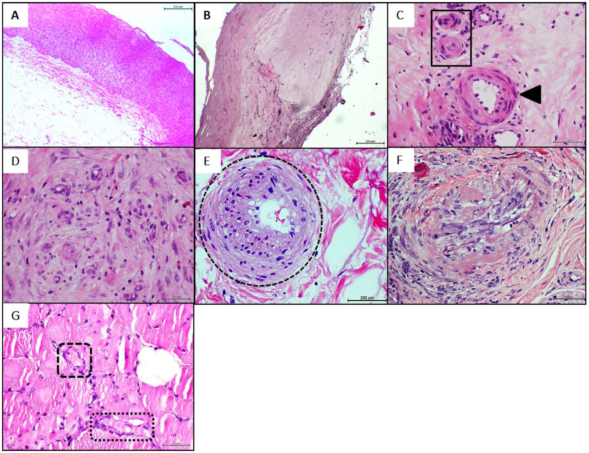 IJMS | Free Full-Text | Intralesional Infiltrations of Arteriosclerotic  Tissue Cells-Free Filtrate Reproduce Vascular Pathology in Healthy  Recipient Rats | HTML