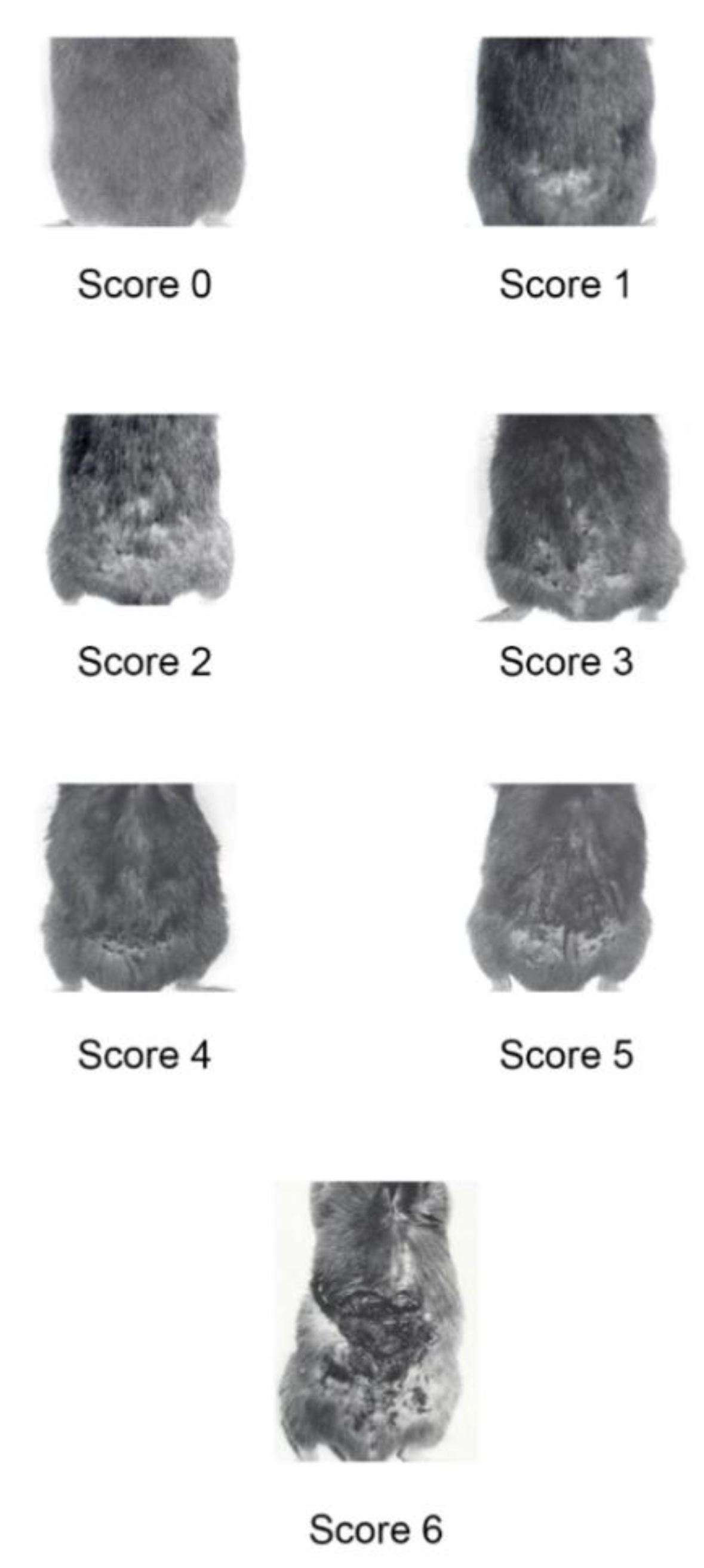 HIV protease inhibitors are potent anti-angiogenic molecules and promote  regression of Kaposi sarcoma