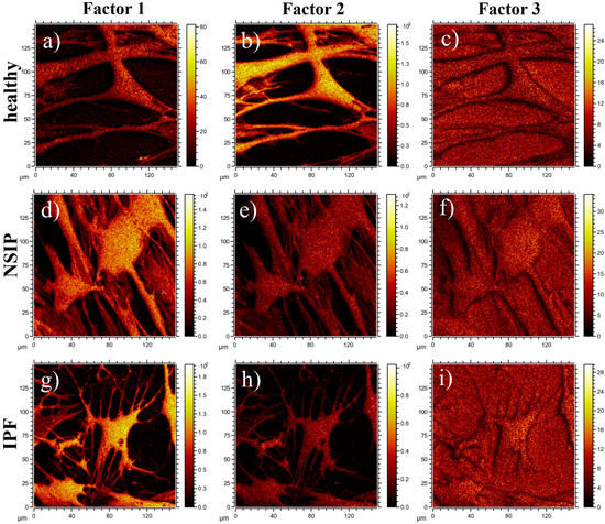 IJMS | Free Full-Text | Discrimination Between NSIP- And IPF-Derived ...