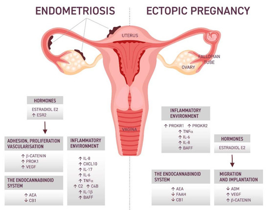 IJMS | Free Full-Text | Molecular Mechanisms Underlying the Association  between Endometriosis and Ectopic Pregnancy