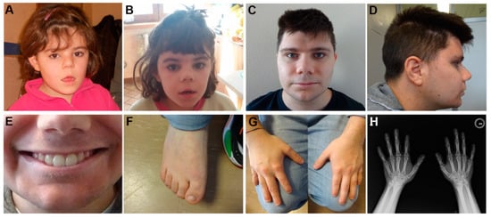 Ijms Free Full Text Expanding The Molecular Spectrum Of Ankrd11 Gene Defects In 33 Patients 