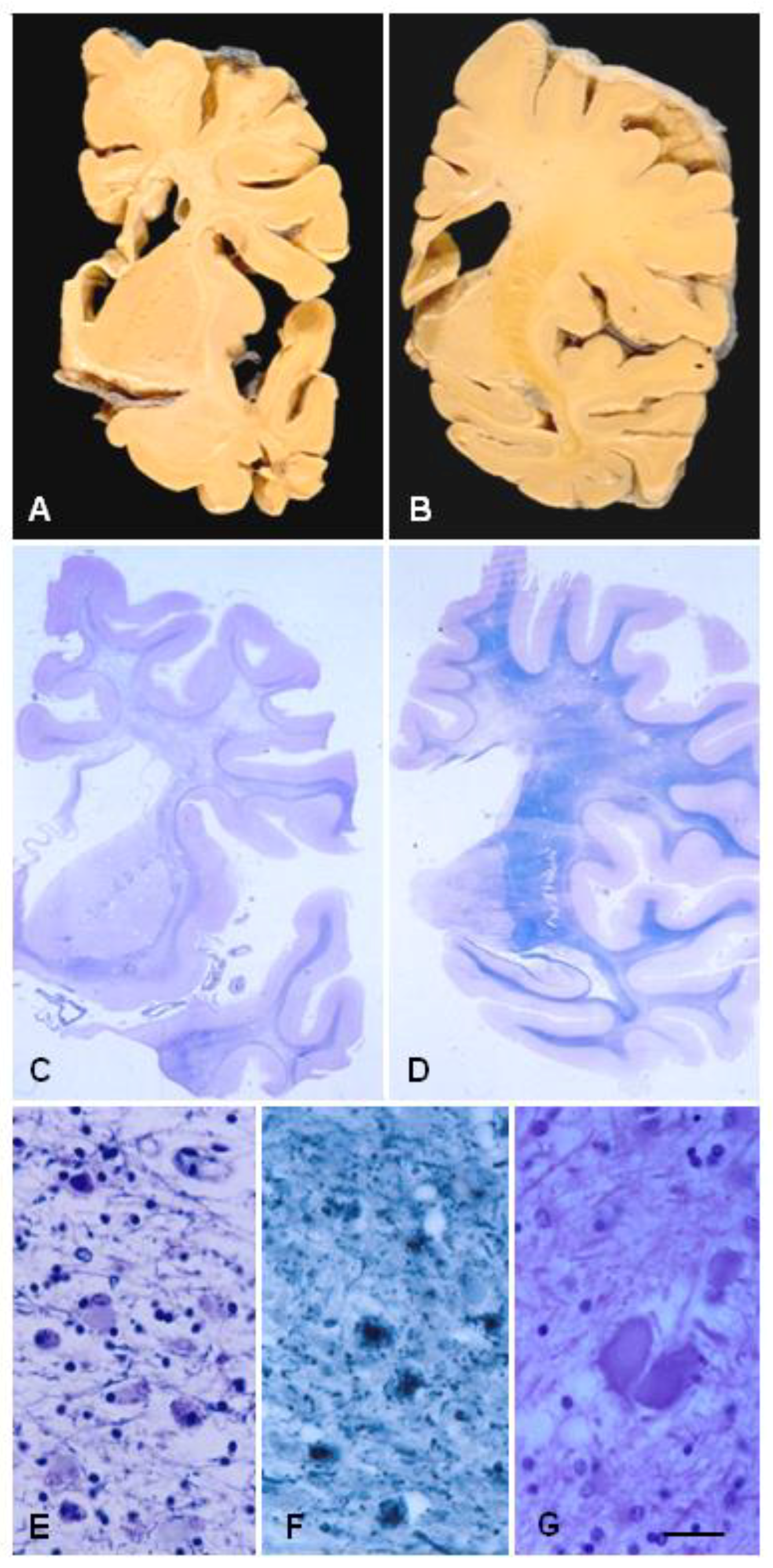 IJMS | Free Full-Text | The Primary Microglial Leukodystrophies: A Review |  HTML