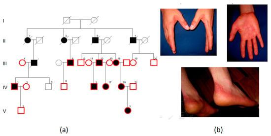 Figure 2. [Dorsal (A) and palmar (B)]. - GeneReviews® - NCBI Bookshelf