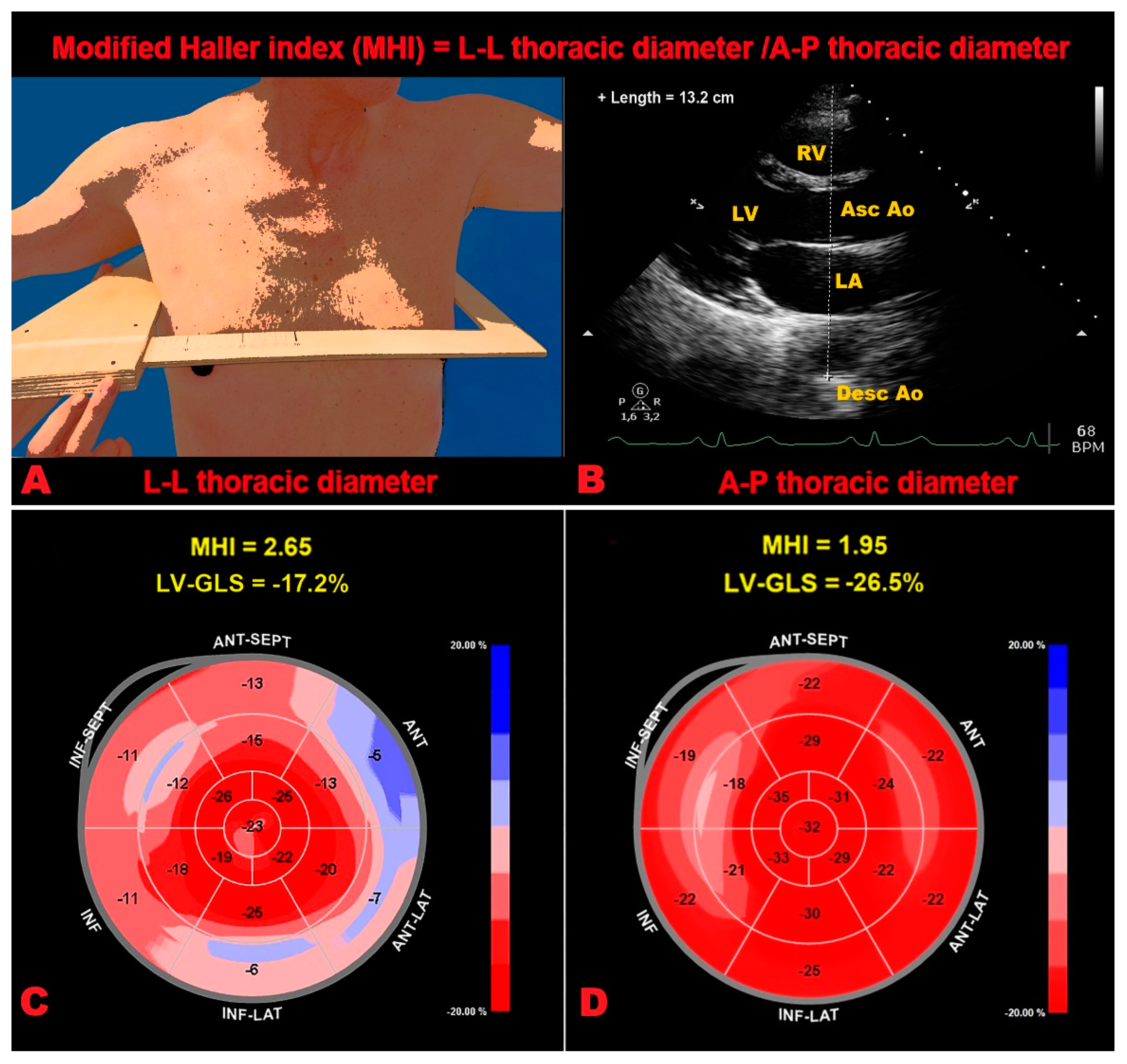 Frontiers  Echocardiographic Global Longitudinal Strain Is Associated With  Myocardial Fibrosis and Predicts Outcomes in Aortic Stenosis