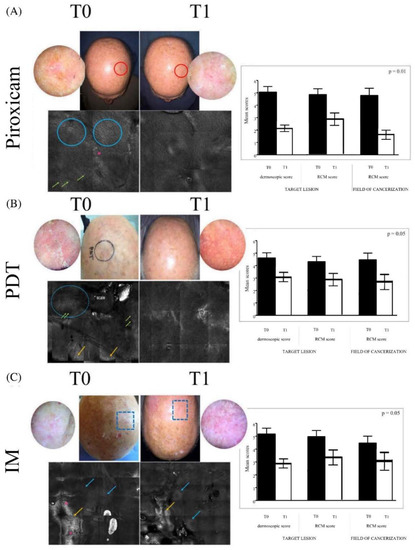 Topical Treatment of Actinic Keratosis and Metalloproteinase  