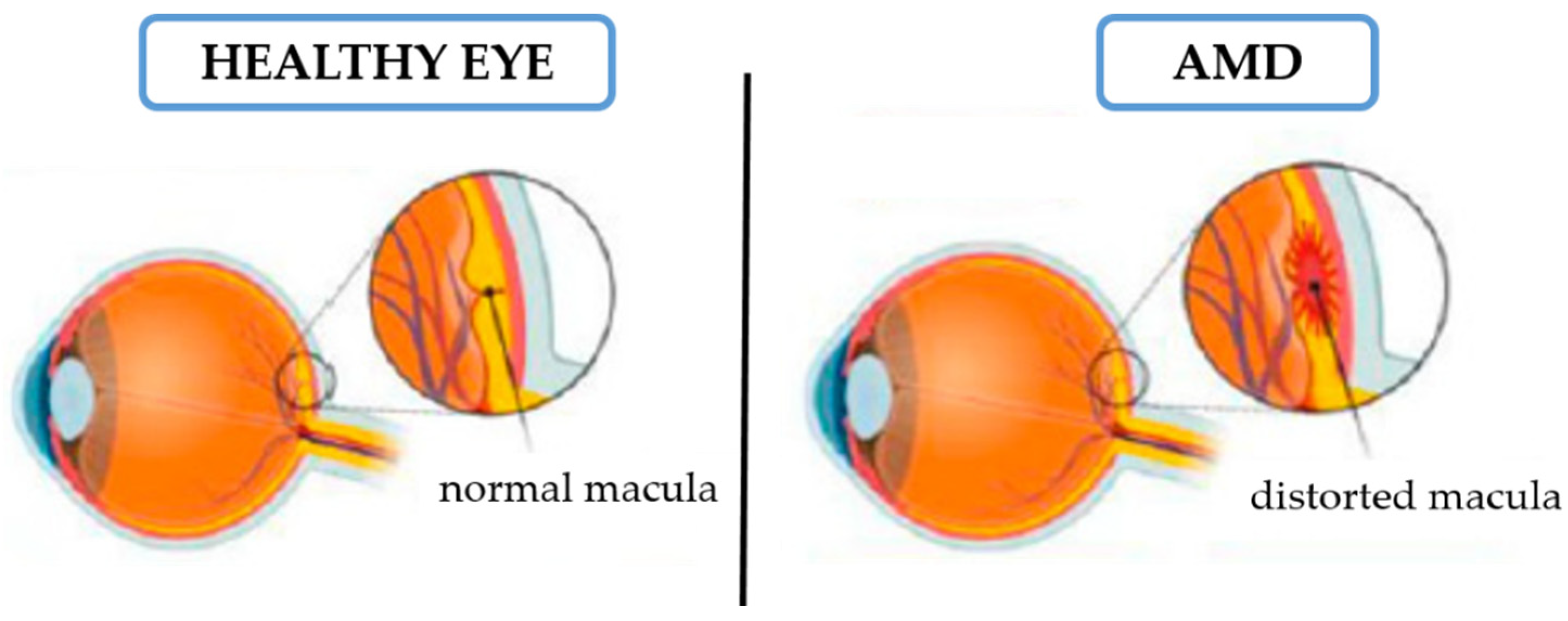 IJMS | Free Full-Text | Therapeutic Approaches for Age-Related Macular  Degeneration