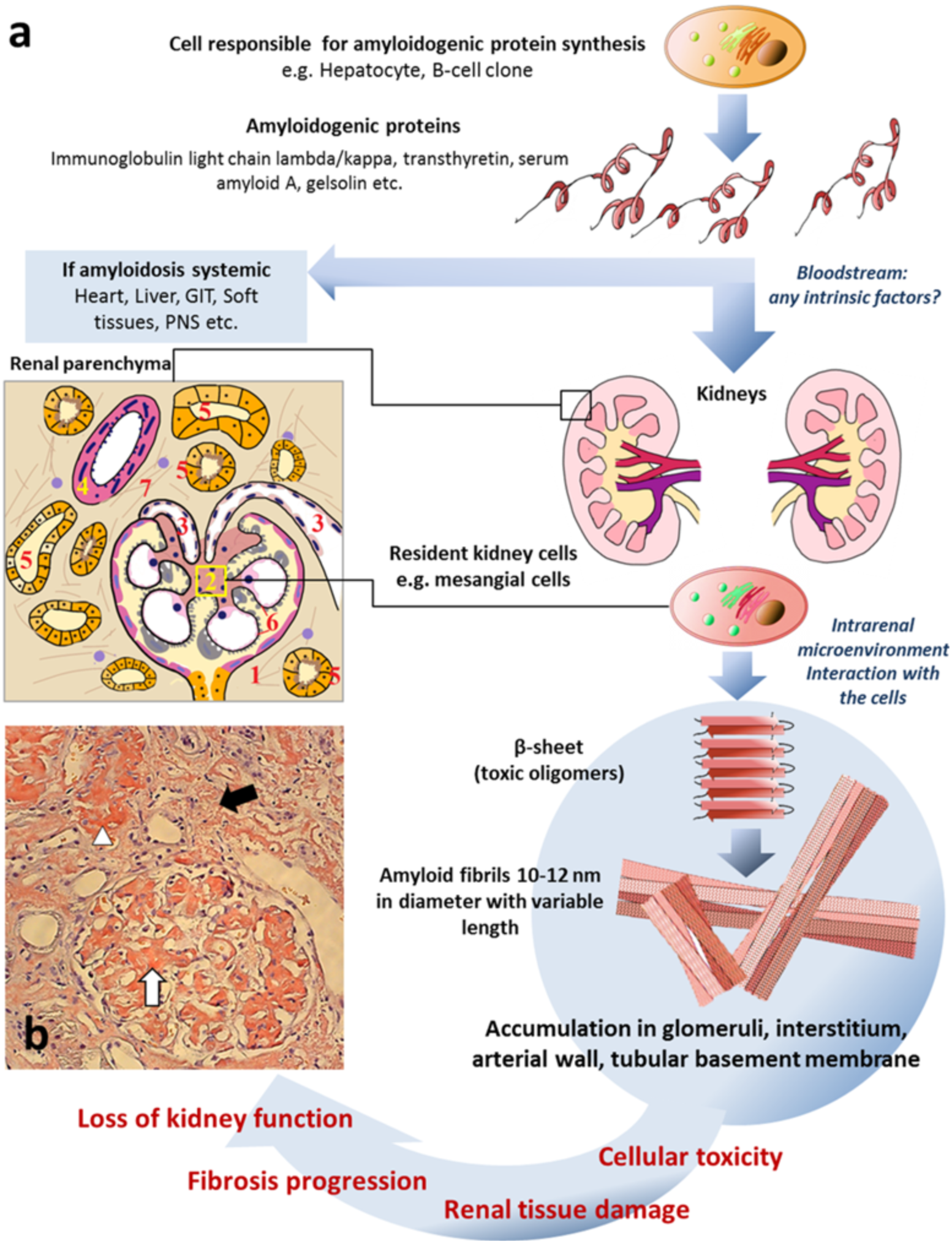 IJMS | Free Full-Text | Noninvasive Diagnostics of Renal Amyloidosis:  Current State and Perspectives