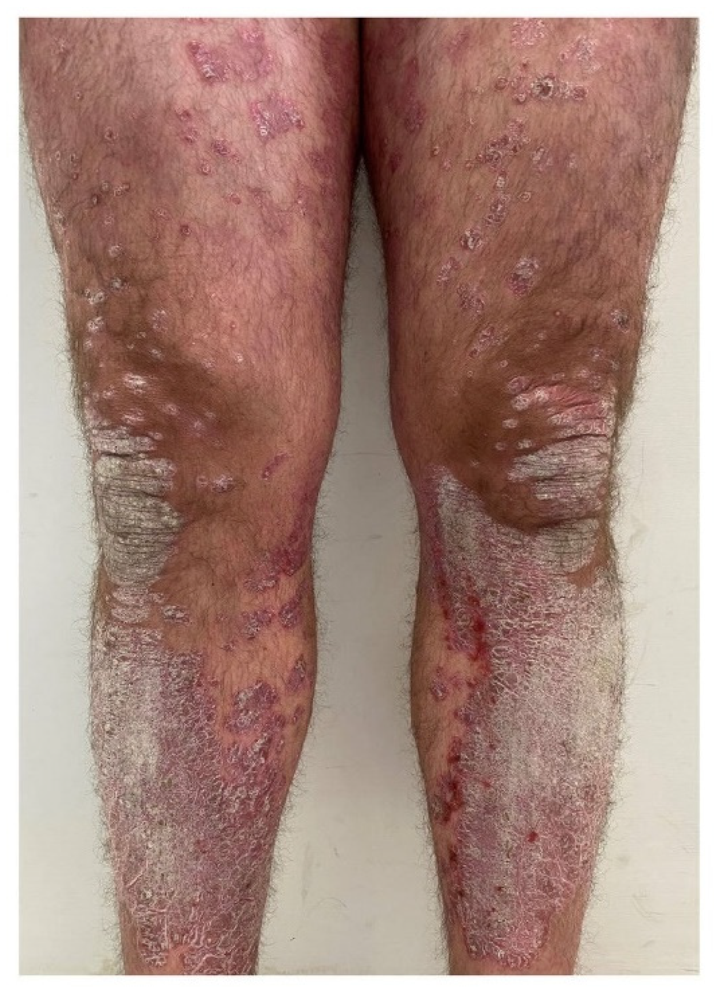 IJMS | Free Full-Text | Could Targeted Pharmacotherapies Exert a &ldquo; Disease Modification Effect&rdquo; in Patients with Chronic Plaque Psoriasis ?
