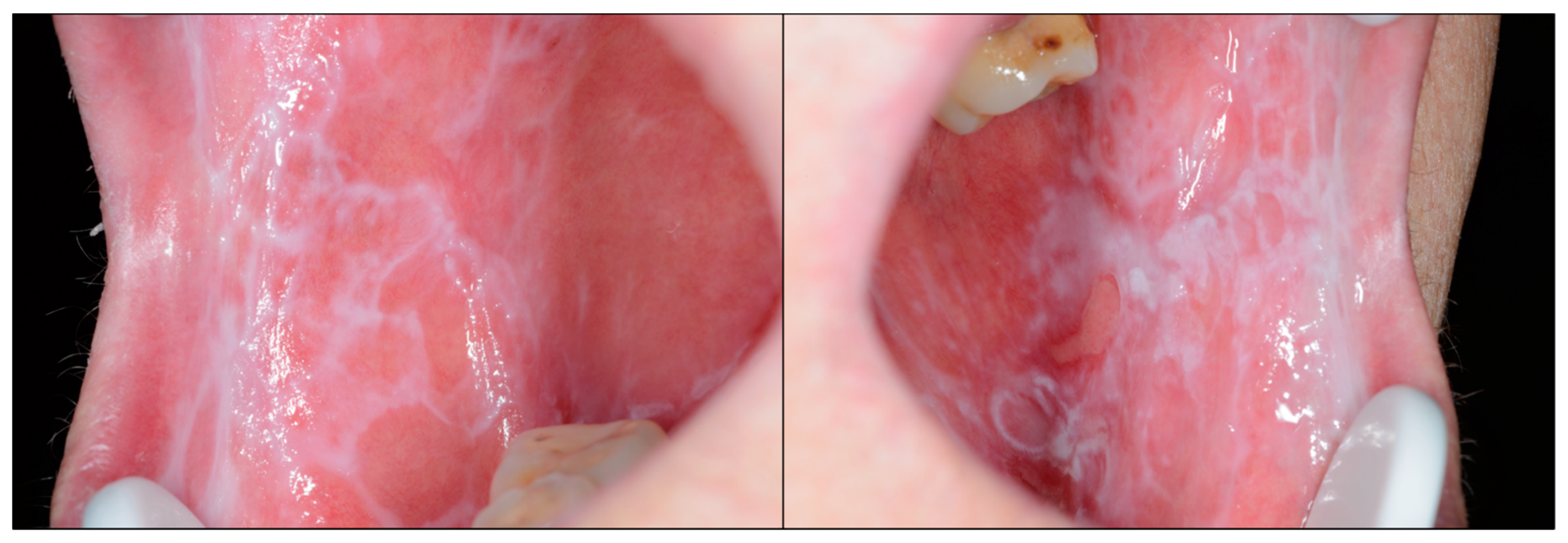 lichen planus mouth lesions