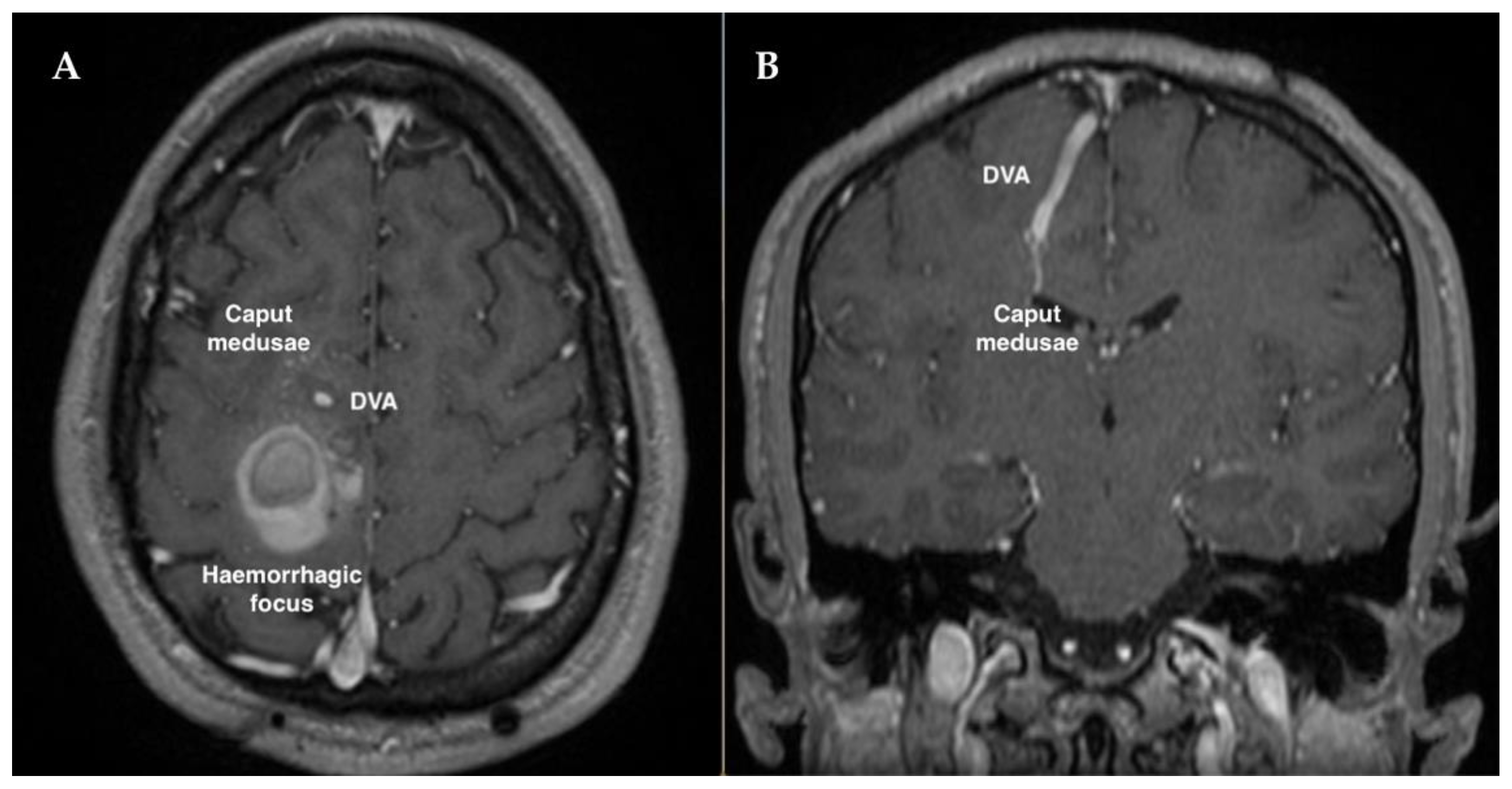 Ijms Free Full Text Distant Recurrence Of A Cerebral Cavernous Malformation In The Vicinity