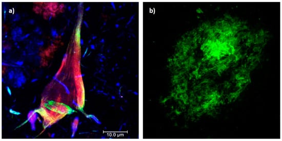 New insights into the genetic etiology of Alzheimer's disease and related  dementias