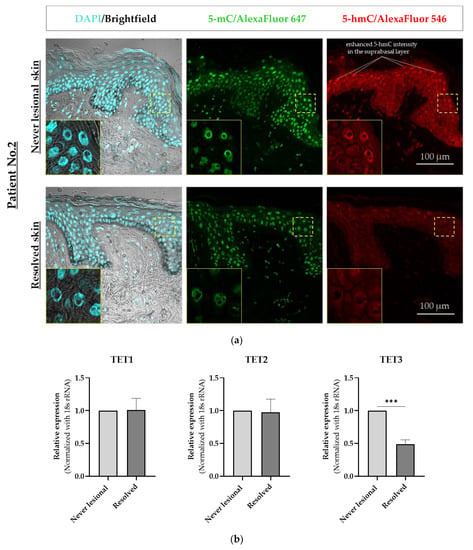 IJMS | Free Full-Text | Psoriatic Resolved Skin Epidermal Keratinocytes ...