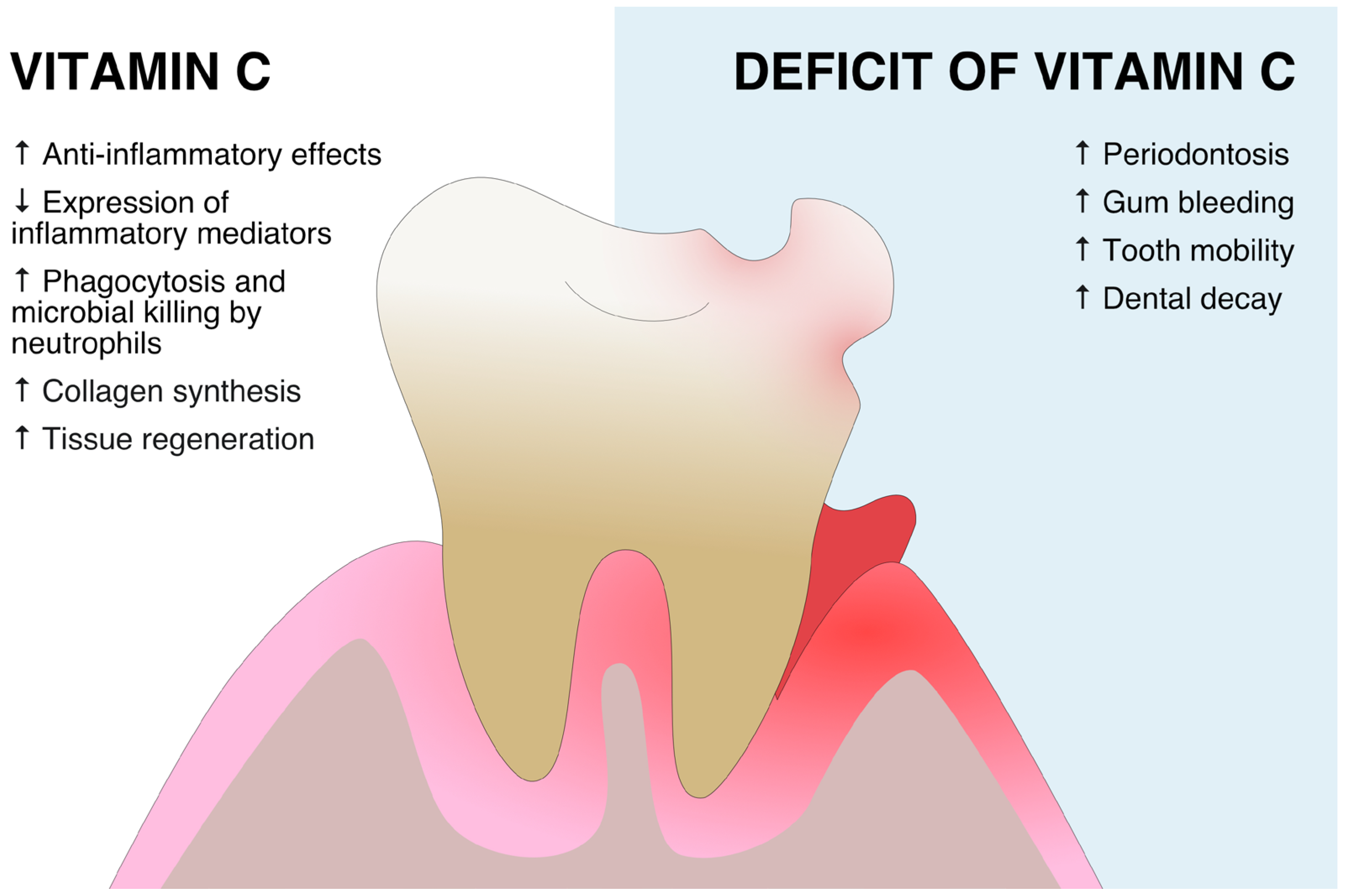 IJMS | Free Full-Text | The Role of Vitamin C and Vitamin D in the  Pathogenesis and Therapy of Periodontitis&mdash;Narrative Review