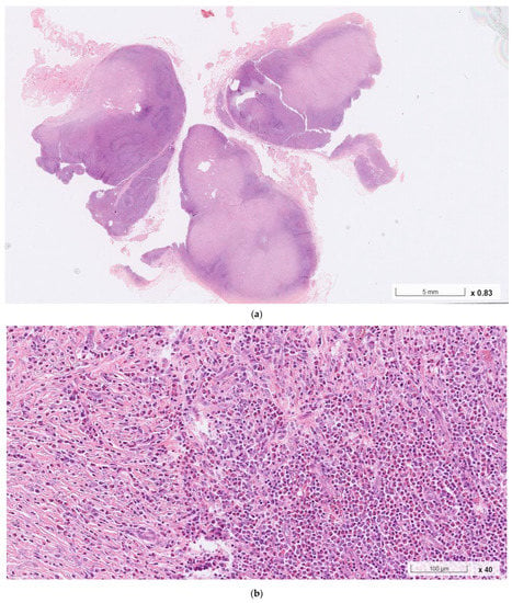 IJMS | Free Full-Text | Coexisting Nodular Sclerosis Hodgkin