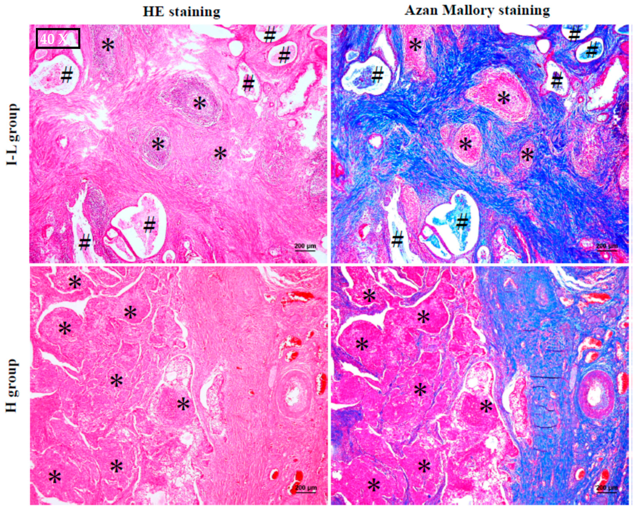IJMS | Free Full-Text | Increased Chymase-Positive Mast Cells in High-Grade  Mucoepidermoid Carcinoma of the Parotid Gland