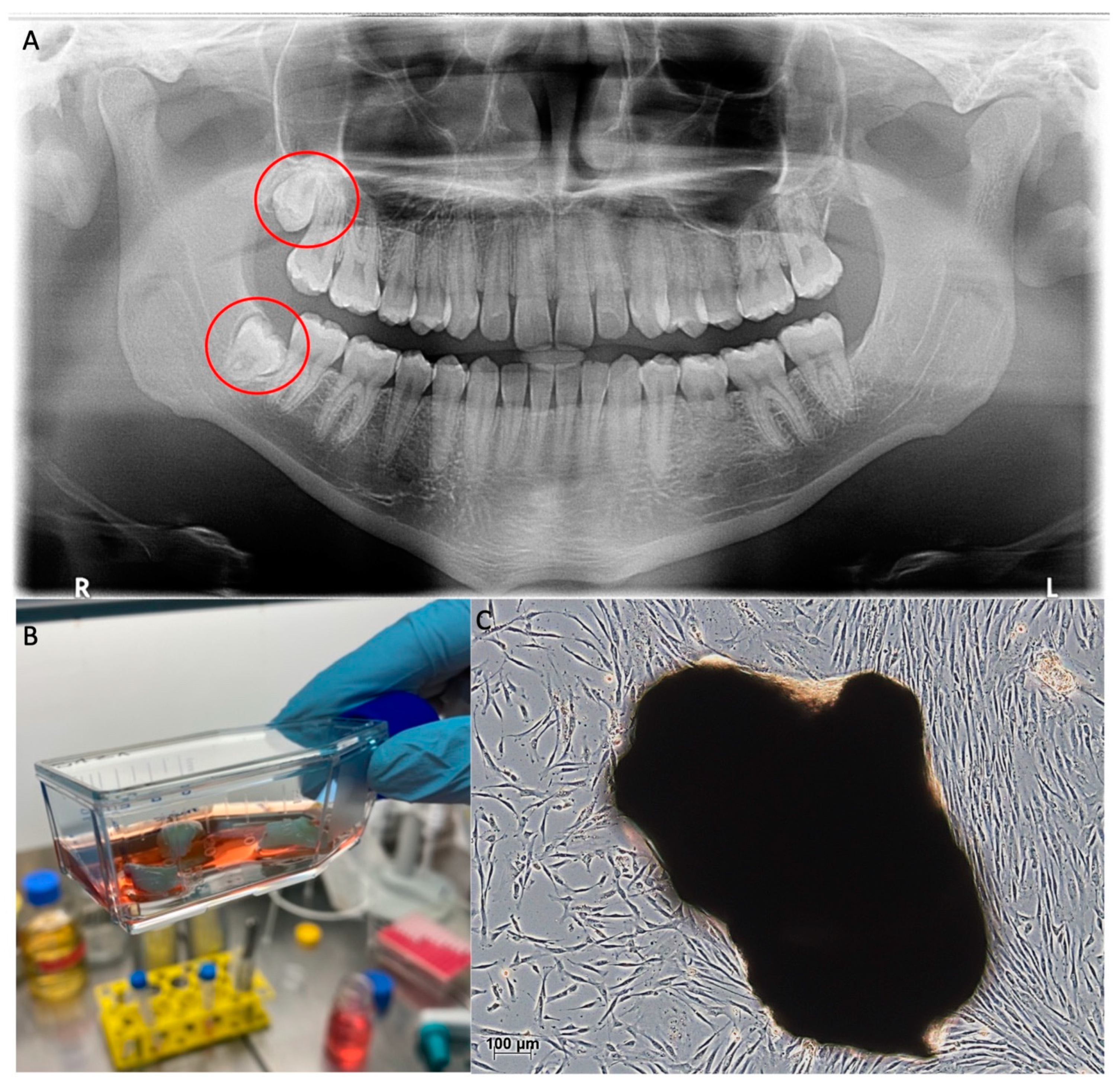 Vitamin D deficiency indicated by pulp tooth shape (X ray)– Nov
