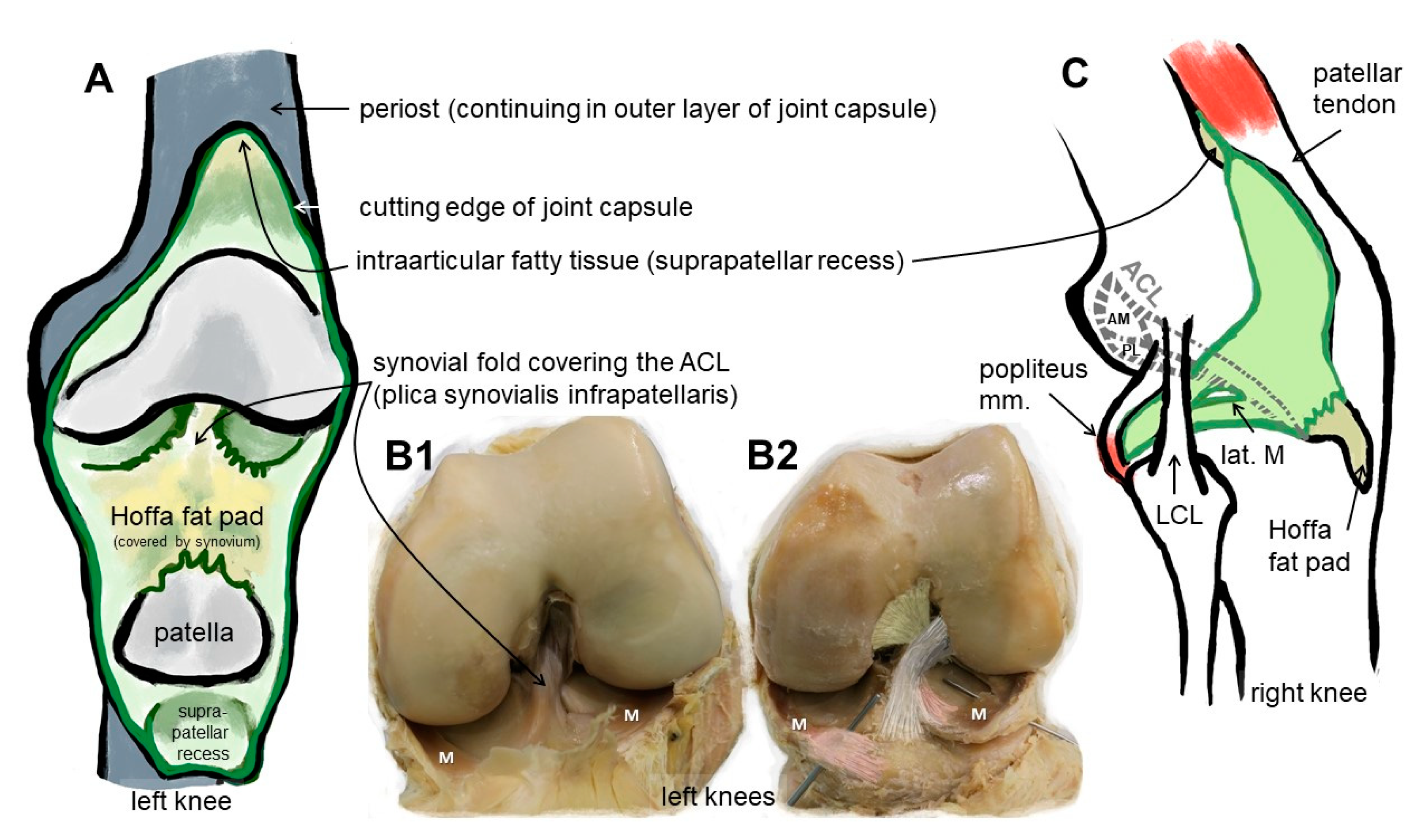 Open Anatomic Reconstruction of the Medial Collateral Ligament and