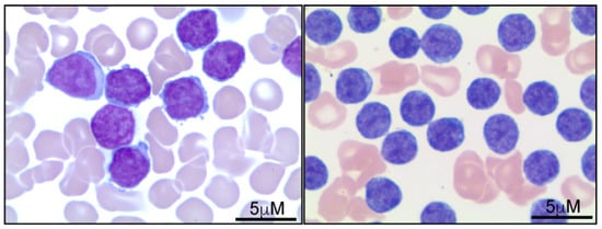 IJMS | Free Full-Text | T-Cell Prolymphocytic Leukemia: Diagnosis ...