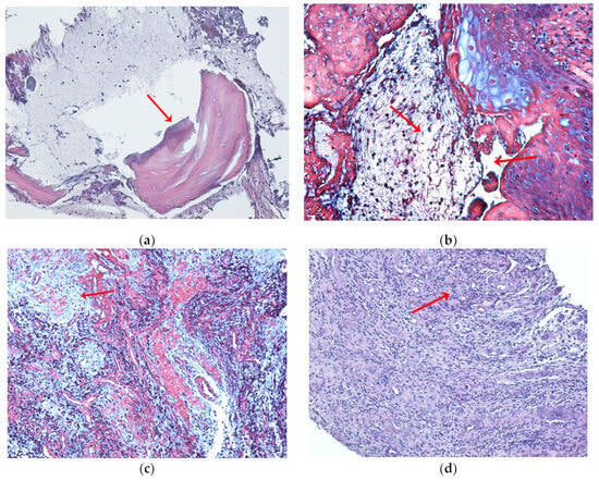 Osteonecrosis development by tooth extraction in zoledronate treated mice  is inhibited by active vitamin D analogues, anti-inflammatory agents or  antibiotics