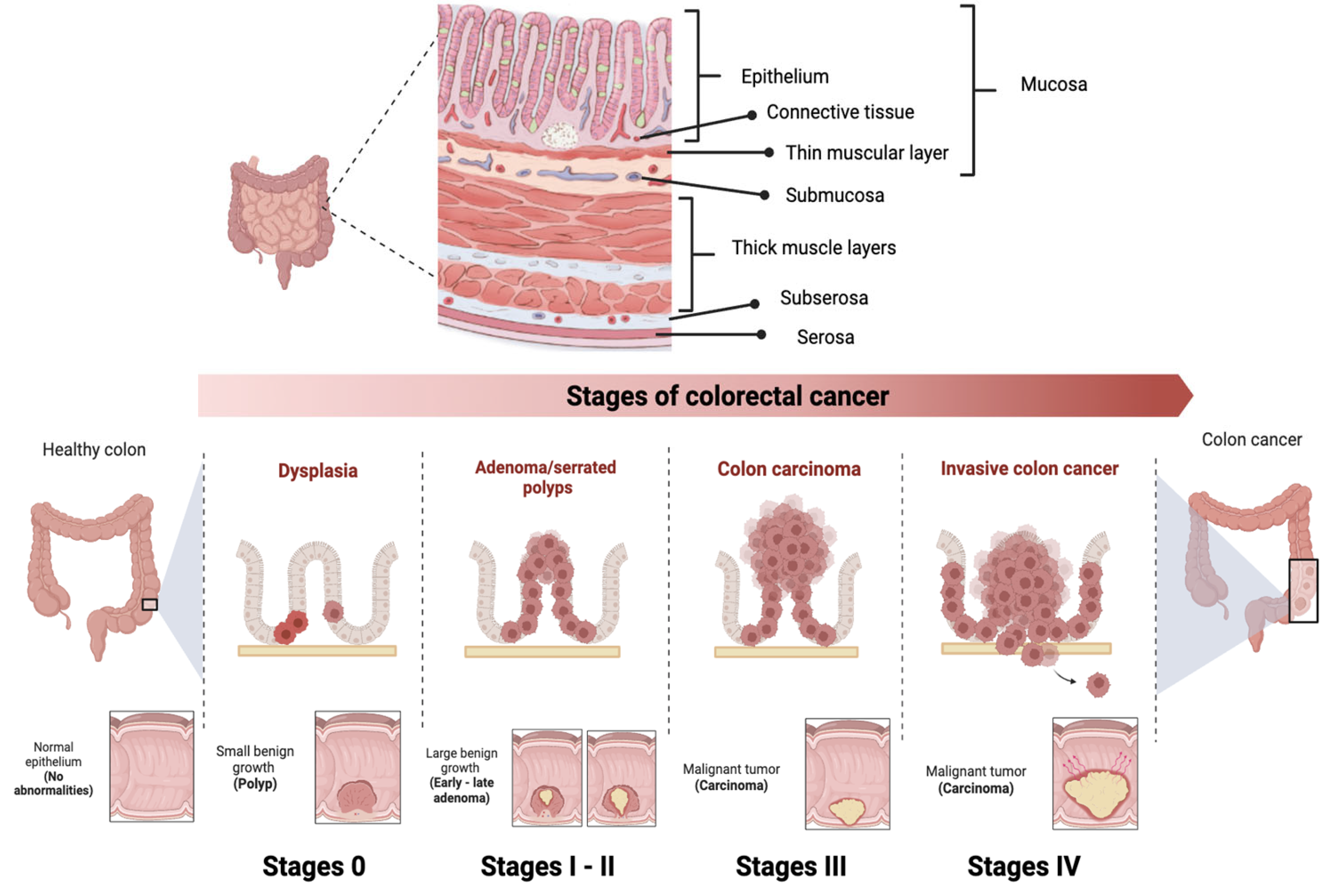 IJMS | Free Full-Text | Clusterin Expression in Colorectal Carcinomas