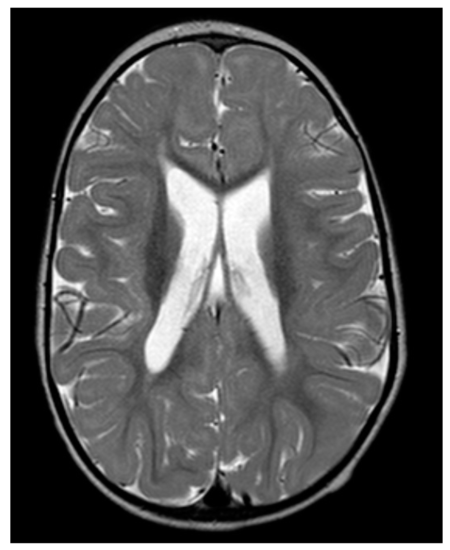 IJMS Free Full Text STXBP6 Gene Mutation A New Form of