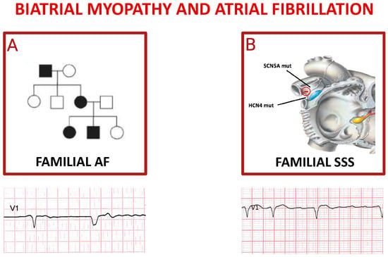 IJMS Free Full Text Pathophysiology of Atrial Fibrillation and