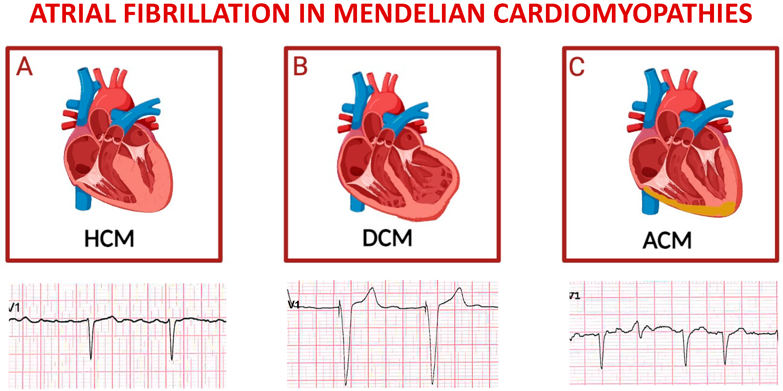 IJMS Free Full Text Pathophysiology of Atrial Fibrillation and