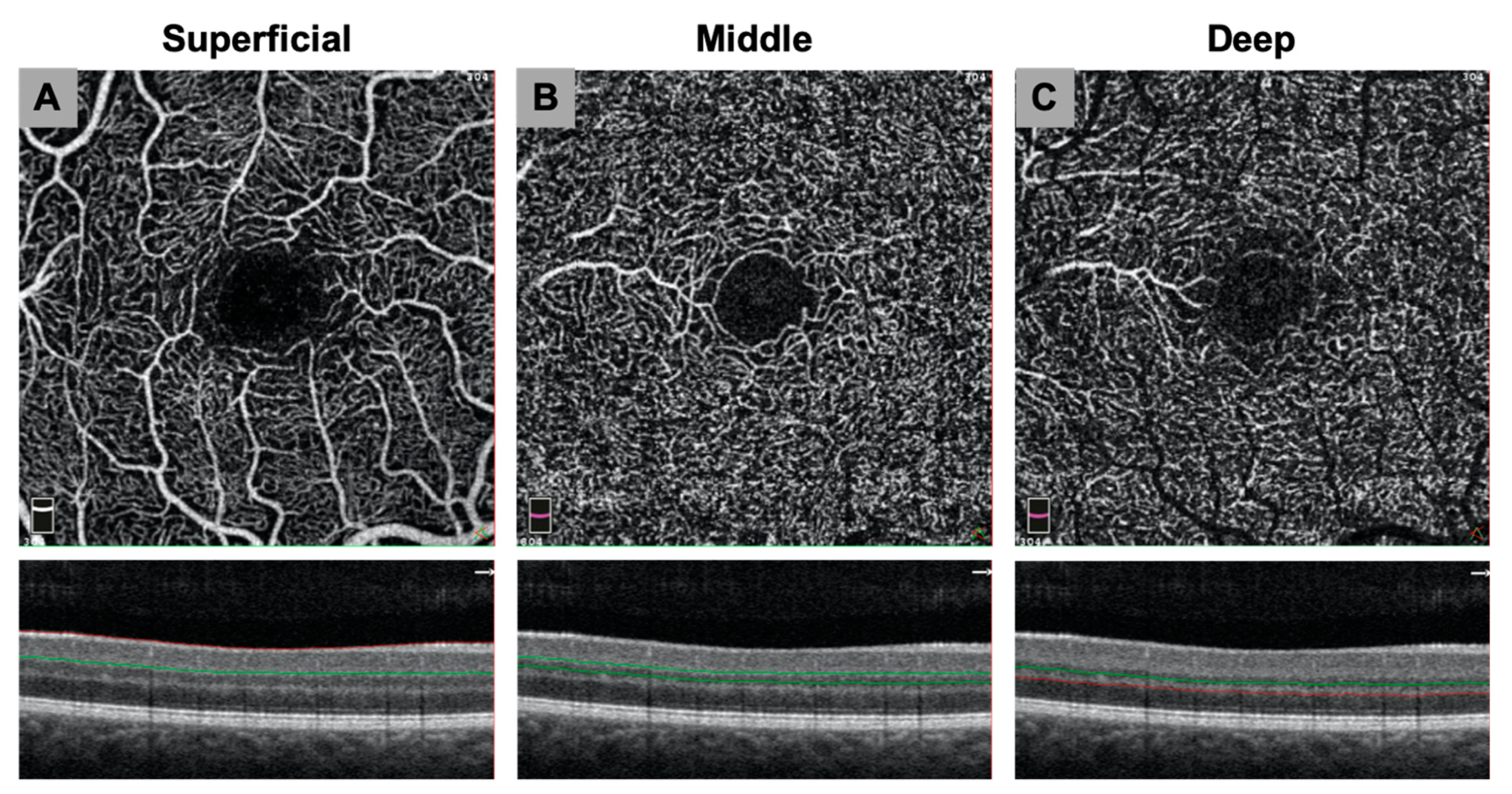 Altered ocular microvasculature in patients with systemic sclerosis and  very early disease of systemic sclerosis using optical coherence tomography  angiography