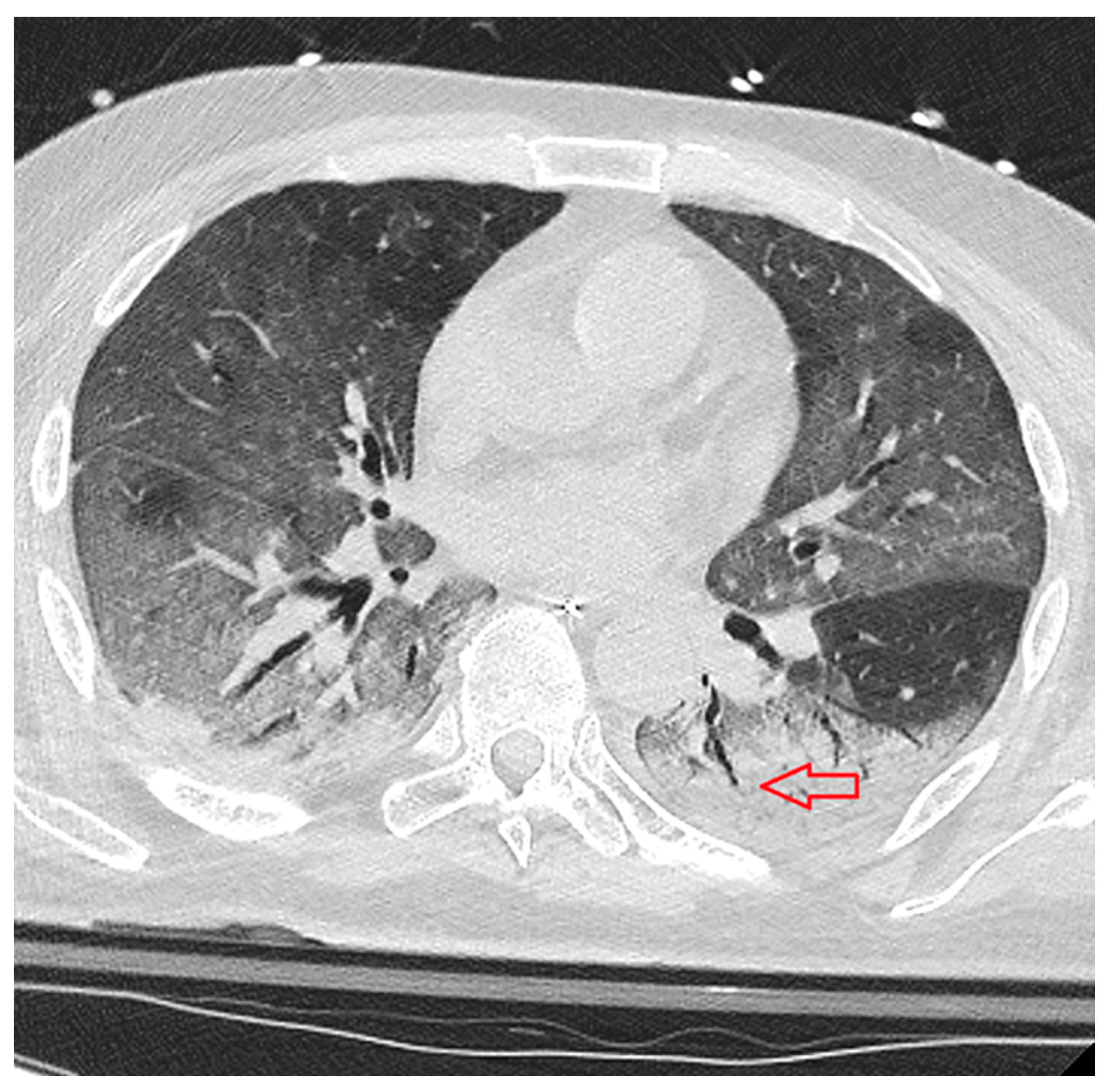 IJTM | Free Full-Text | A New HRCT Score for Diagnosing SARS-CoV-2 