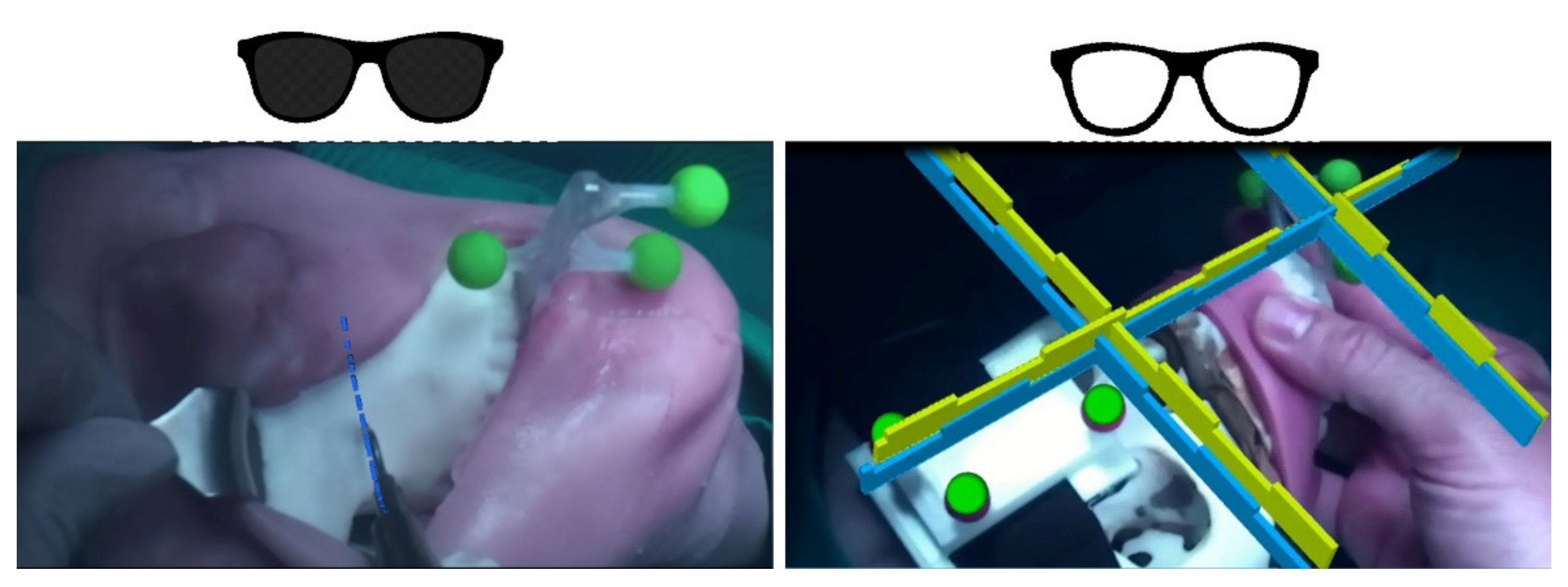 Information | Free Full-Text | Architecture of a Hybrid Video/Optical  See-through Head-Mounted Display-Based Augmented Reality Surgical  Navigation Platform | HTML