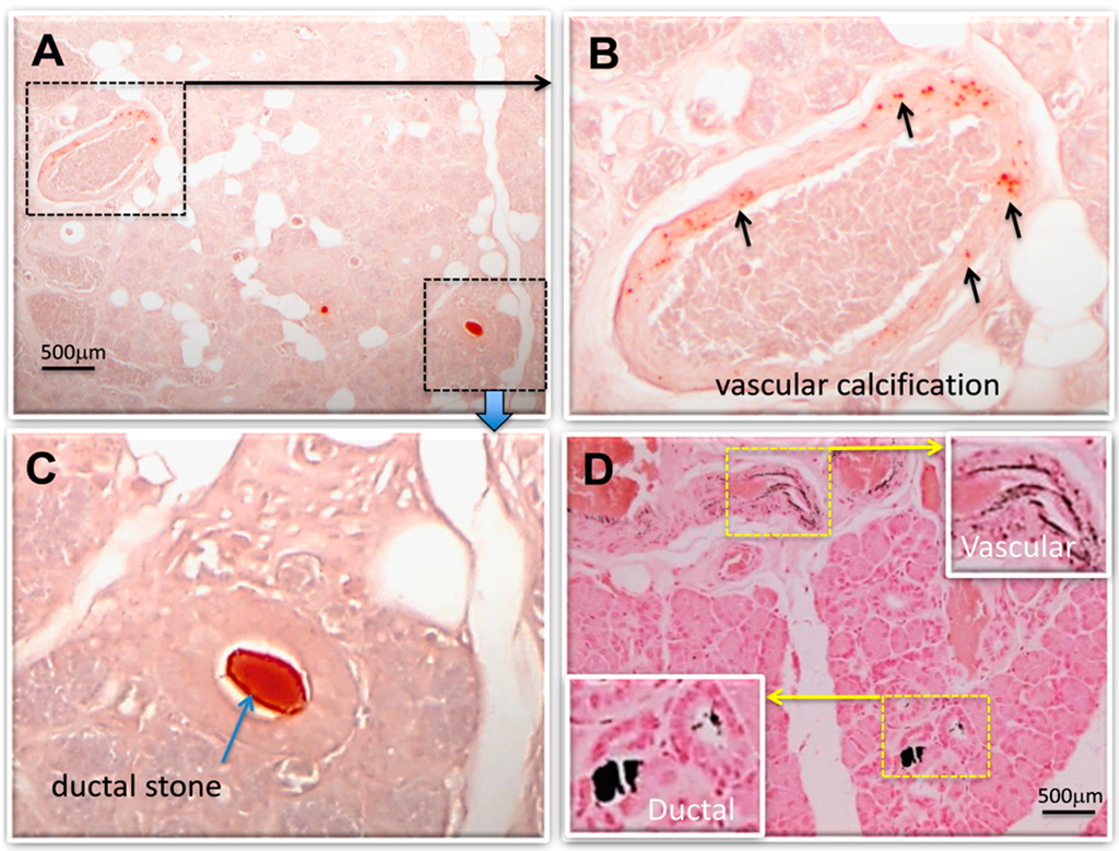 JCDD | Free Full-Text | Vascular Calcification And Stone Disease: A New ...