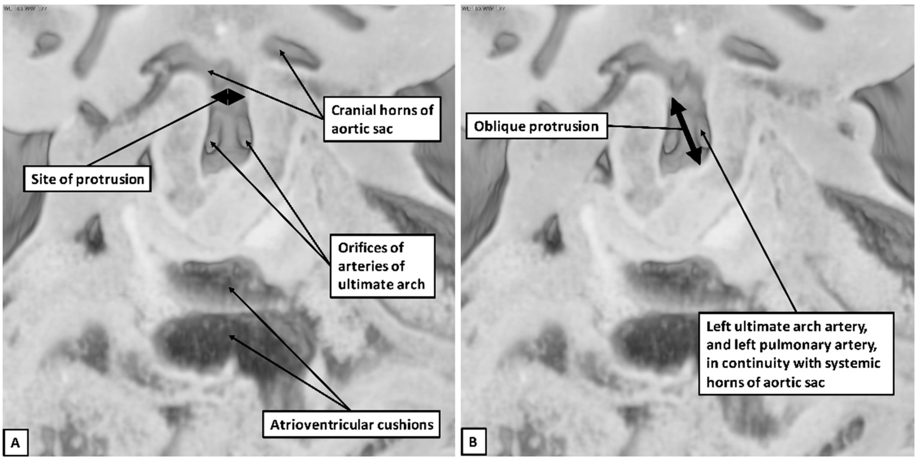 JCDD | Free Full-Text | Left Pulmonary Artery from the Ascending Aorta ...