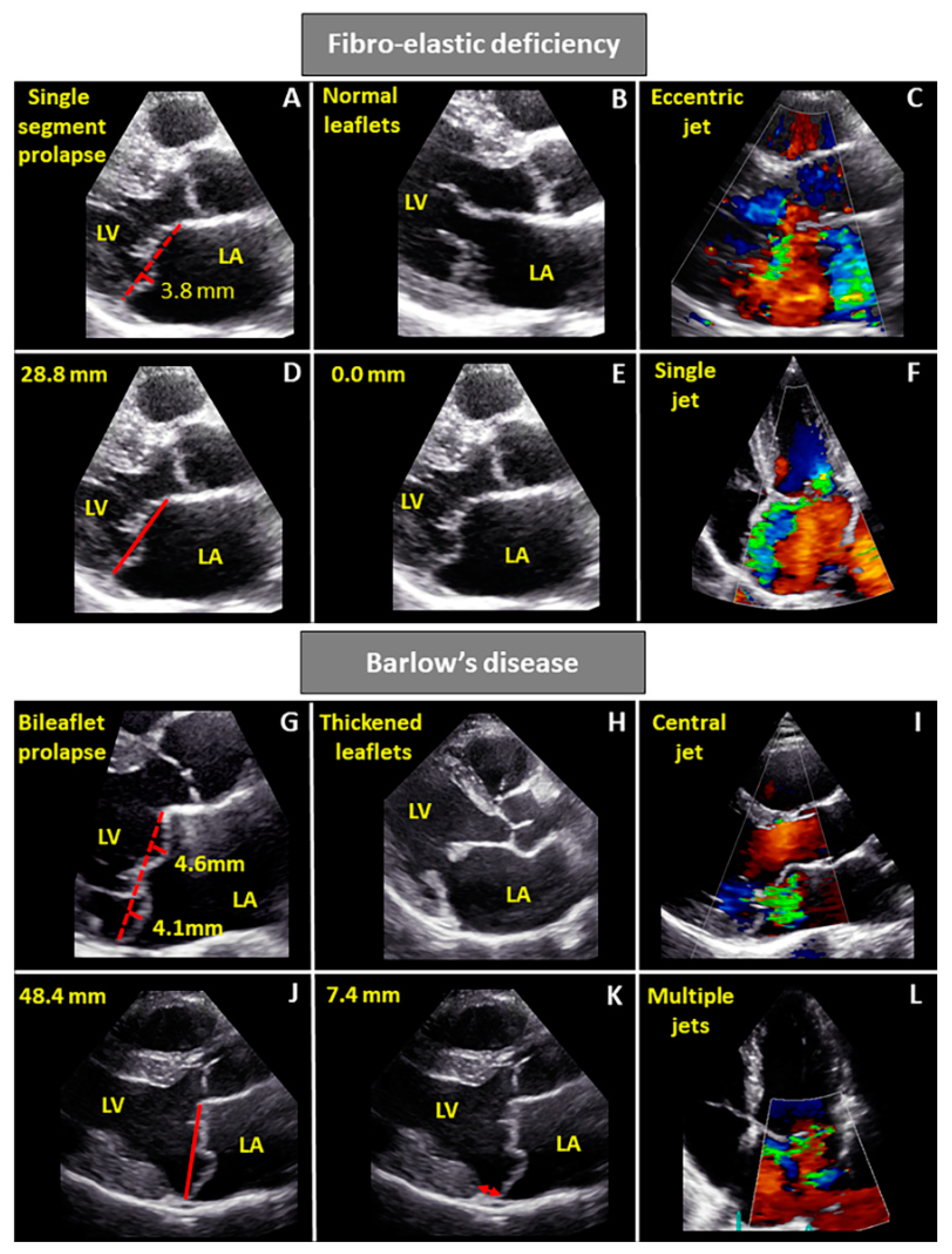 JCDD | Free Full-Text | Characterization of Degenerative Mitral Valve  Disease: Differences between Fibroelastic Deficiency and Barlow's Disease