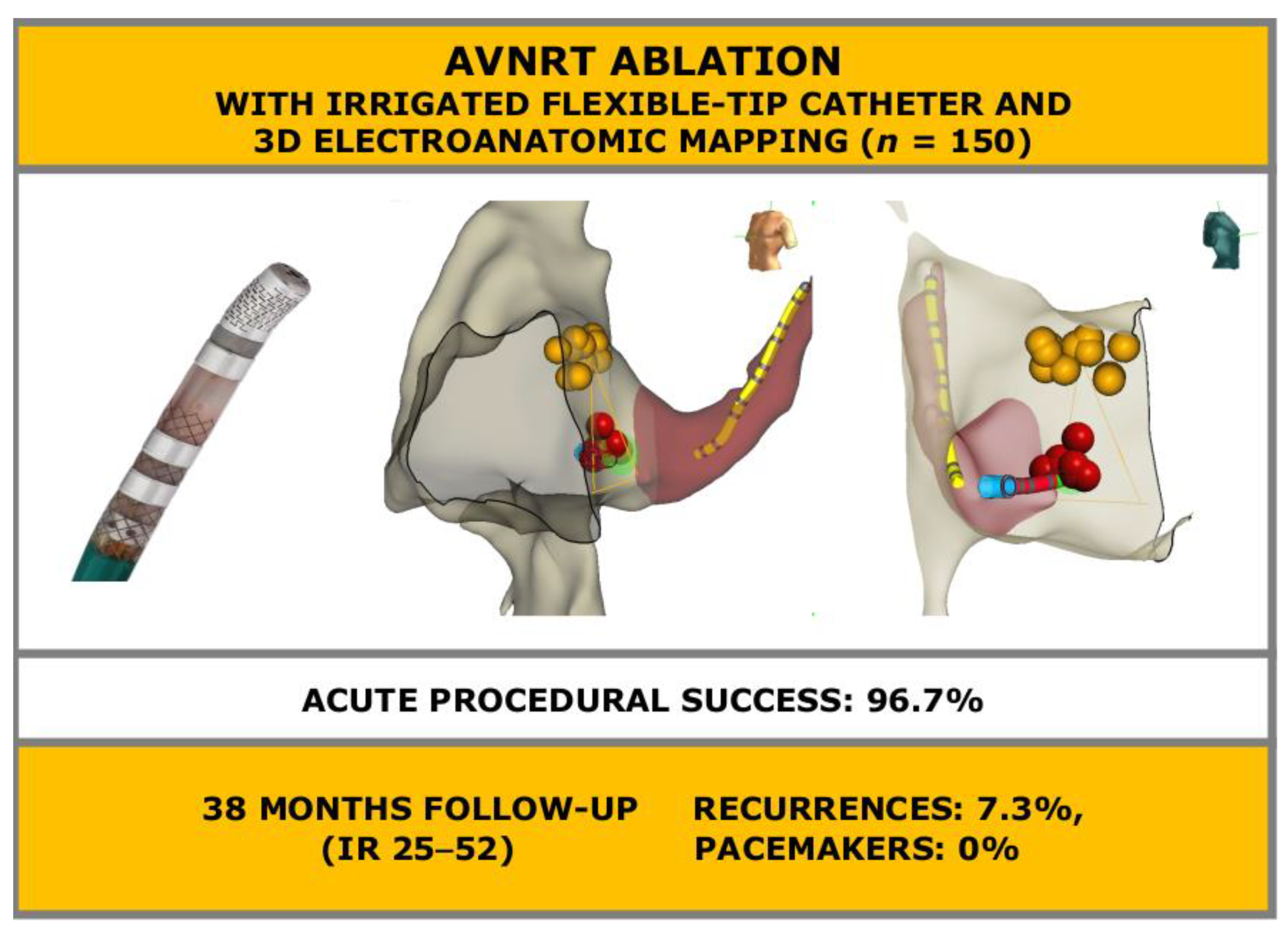 JCDD | Free Full-Text | Ablation of Atrioventricular Nodal Re-Entrant  Tachycardia Combining Irrigated Flexible-Tip Catheters and  Three-Dimensional Electroanatomic Mapping: Long-Term Outcomes