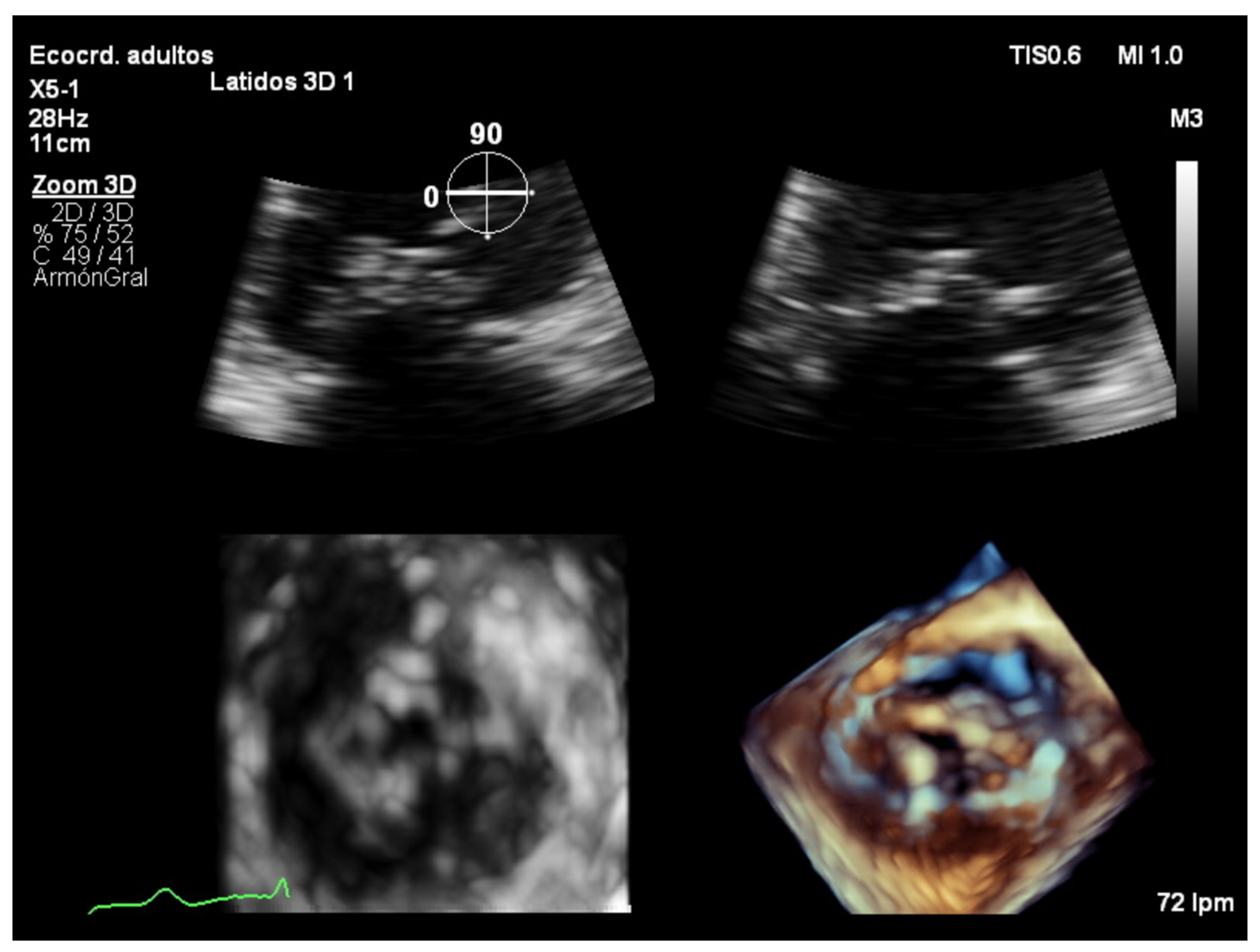 Jcdd Free Full Text The Role Of 2d And 3d Echo In Mitral Stenosis Html