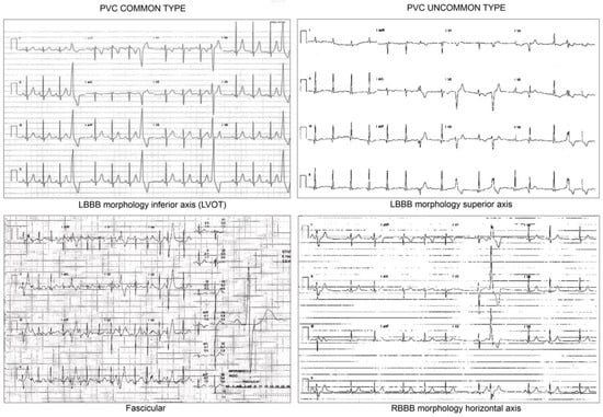 Assessment of subtle cardiac dysfunction induced by premature ventricular  contraction using two-dimensional strain echocardiography and the effects  of successful ablation
