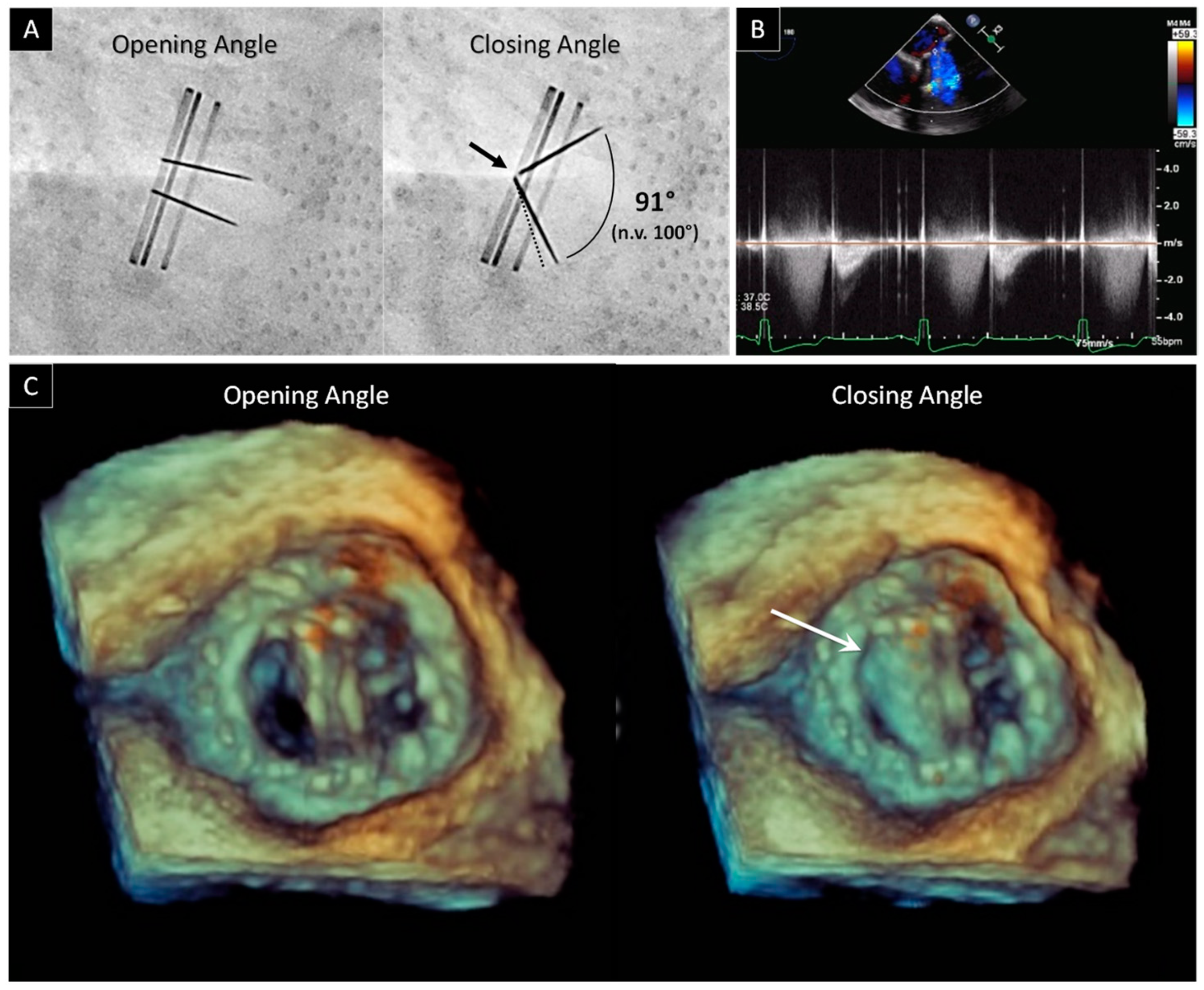 JCDD | Free Full-Text | The Role of Multimodality Imaging in Left-Sided  Prosthetic Valve Dysfunction