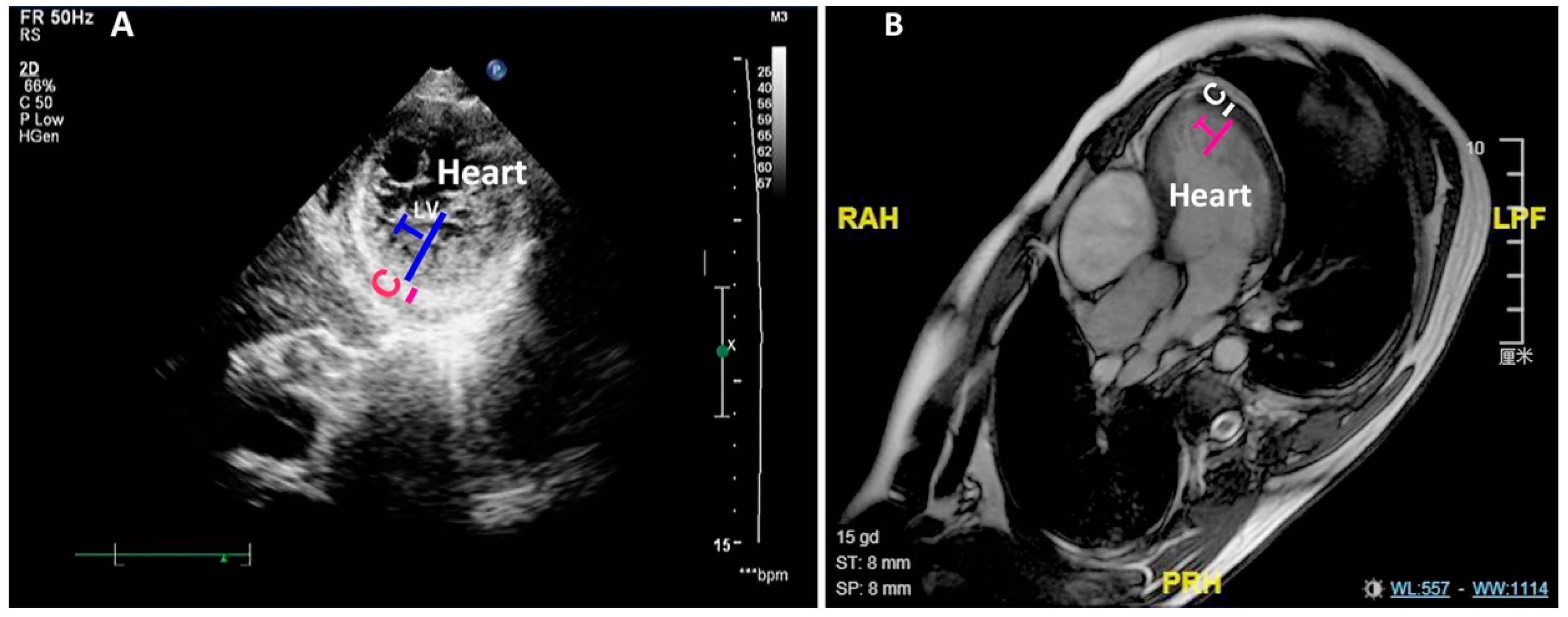 JCDD | Free Full-Text | Left Ventricular Noncompaction Is Associated with  Valvular Regurgitation and a Variety of Arrhythmias