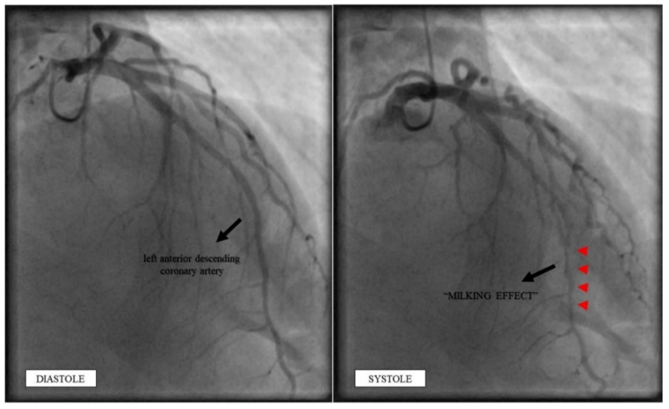 Update on Myocardial Bridging