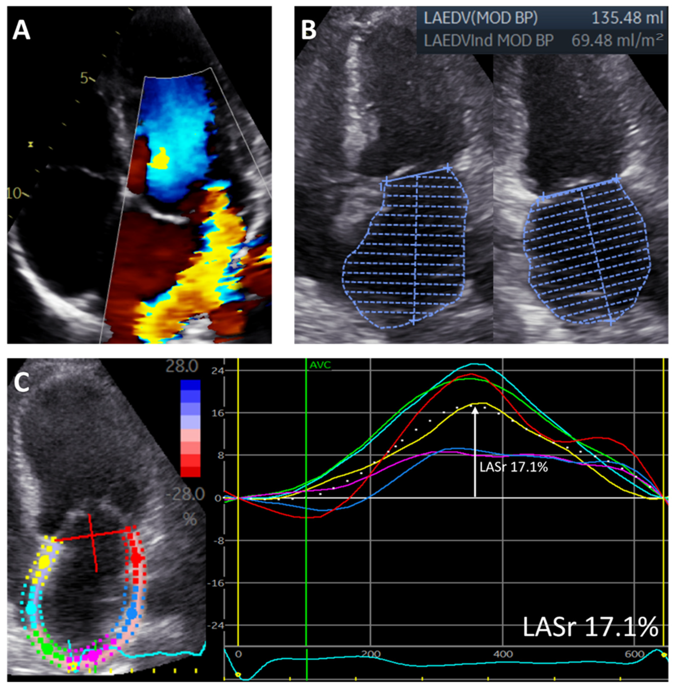 Prognostic Value of Global Longitudinal Strain and Etiology After Surgery  for Primary Mitral Regurgitation