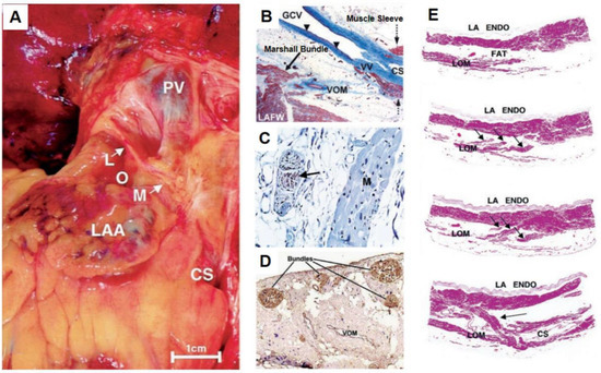 JCDD | Free Full-Text | Ethanol Infusion of Vein of Marshall for