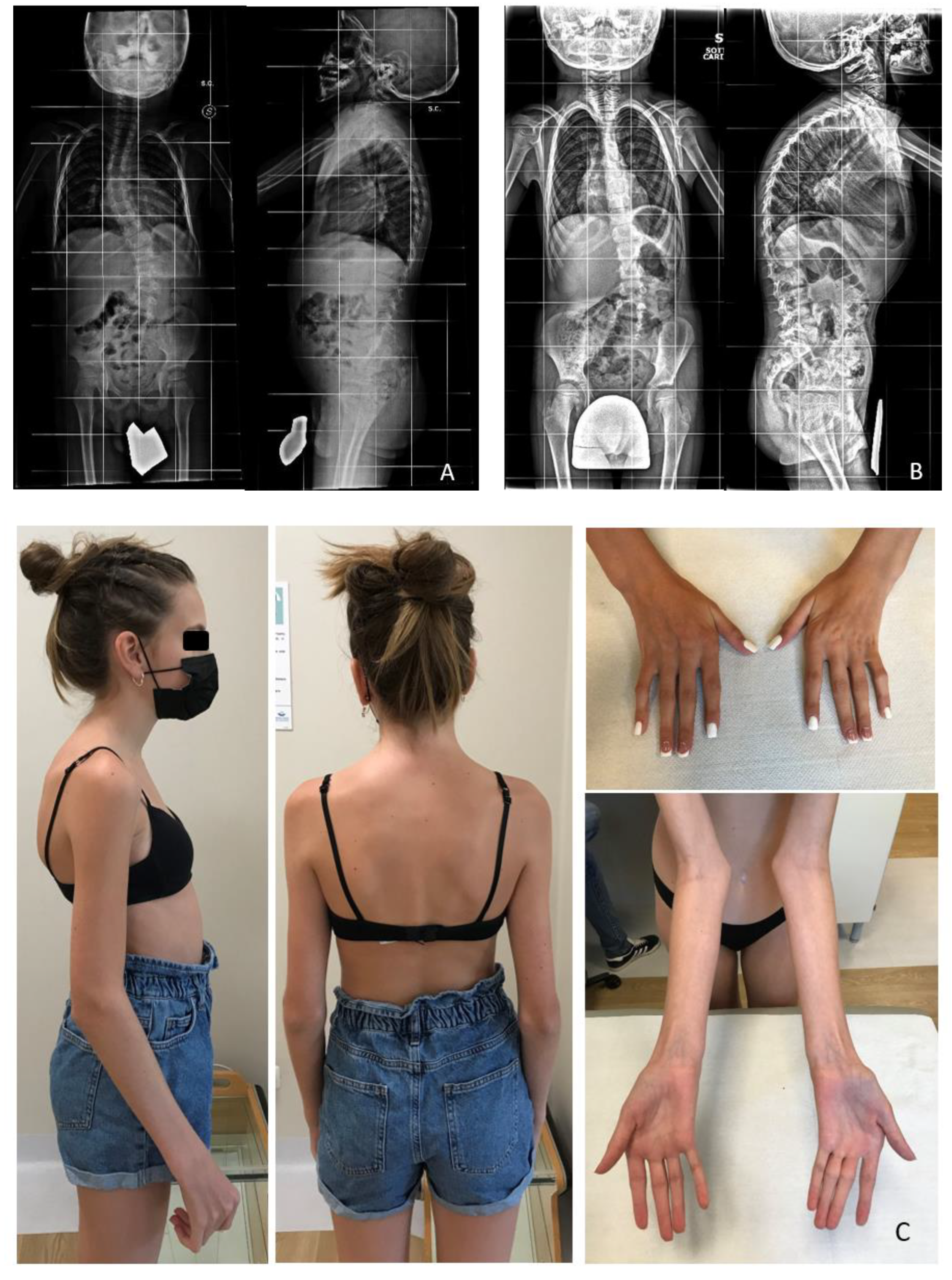 FLNC-Associated Myofibrillar Myopathy