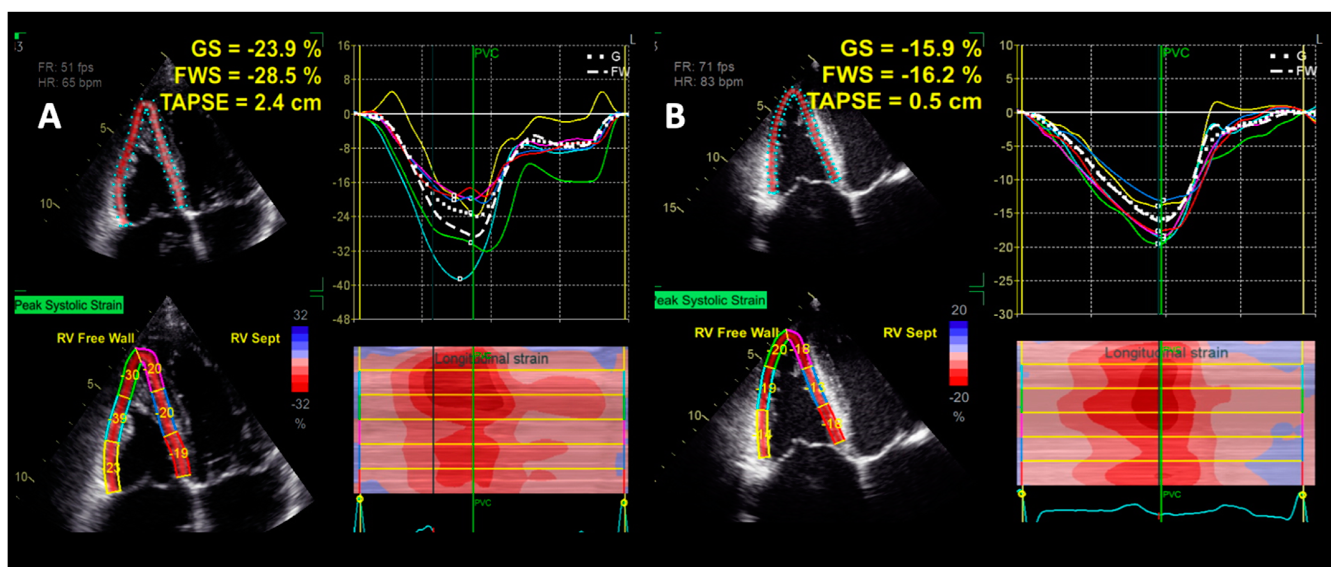 Speckle tracking right ventricular myocardial strain post-percut