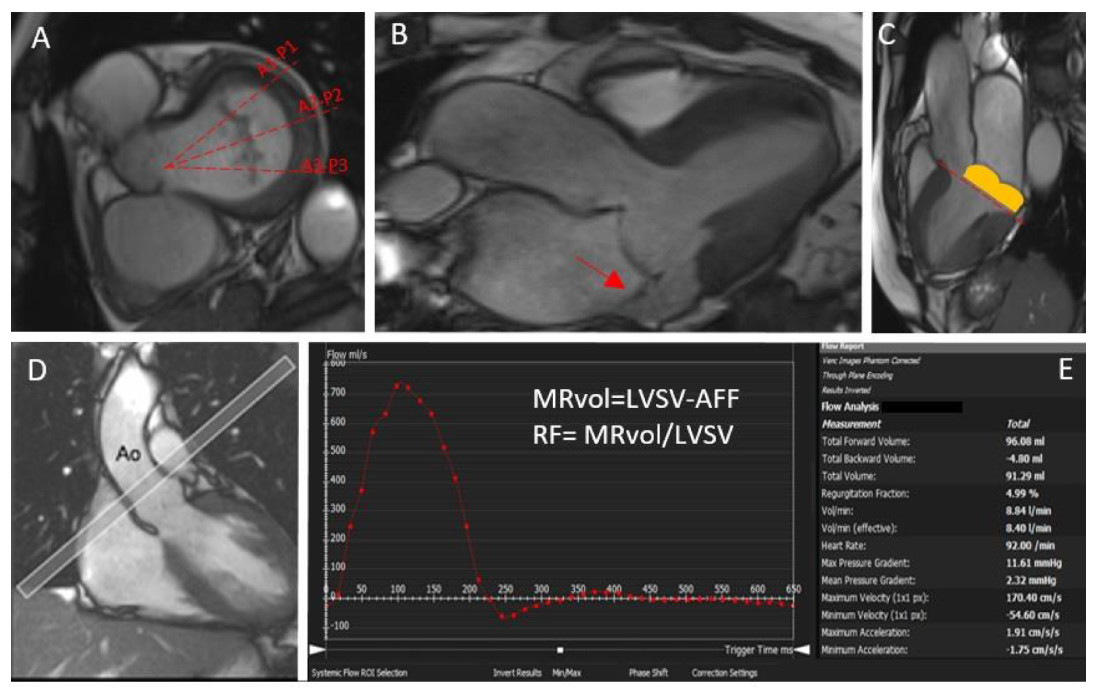 Direct mitral regurgitation quantification in hypertrophic cardiomyopathy  using 4D flow CMR jet tracking: evaluation in comparison to conventional  CMR, Journal of Cardiovascular Magnetic Resonance