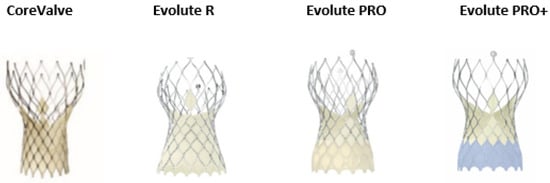 JCDD | Free Full-Text | Personalised Treatment in Aortic Stenosis: A ...