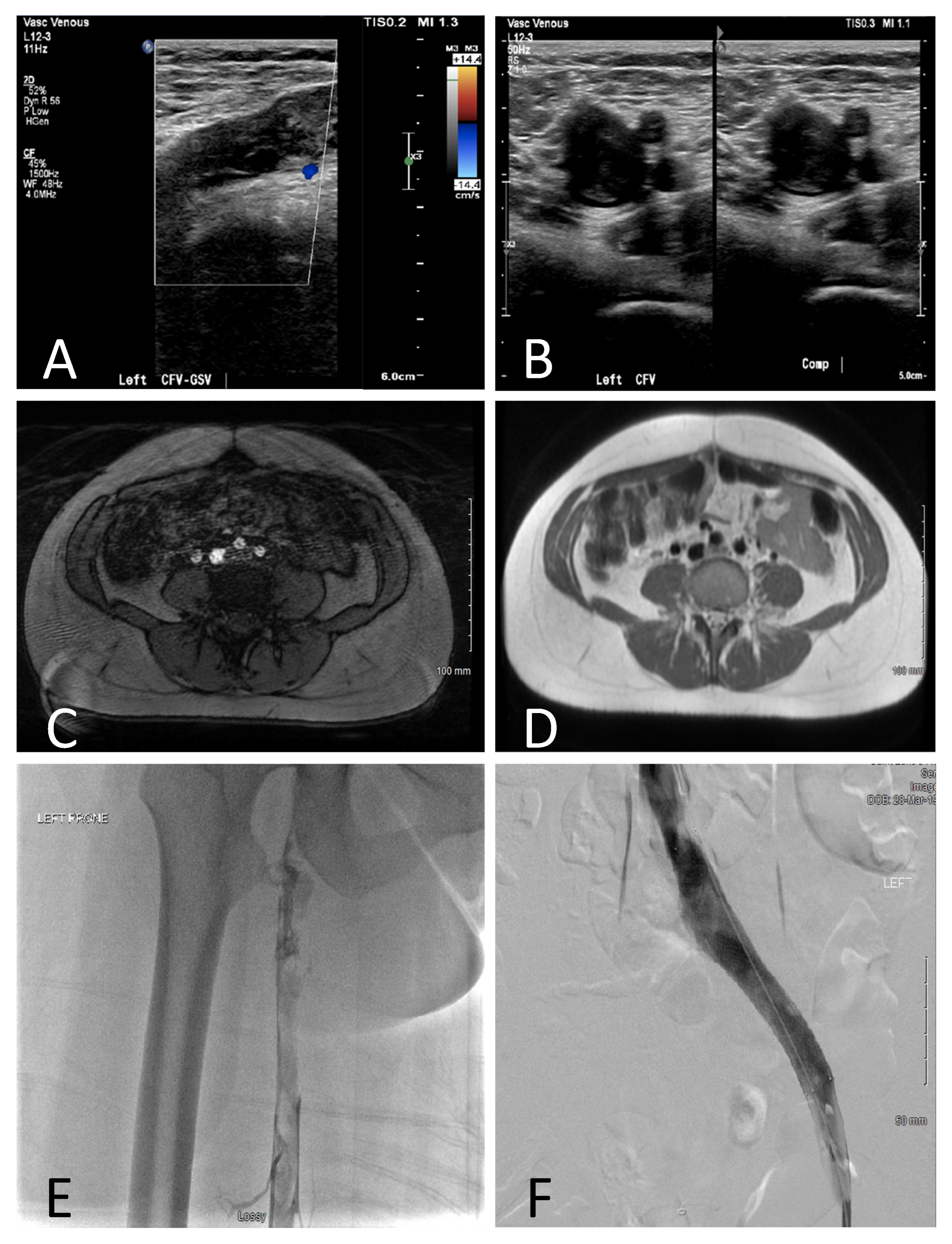 May Thurner Syndrome Treatment