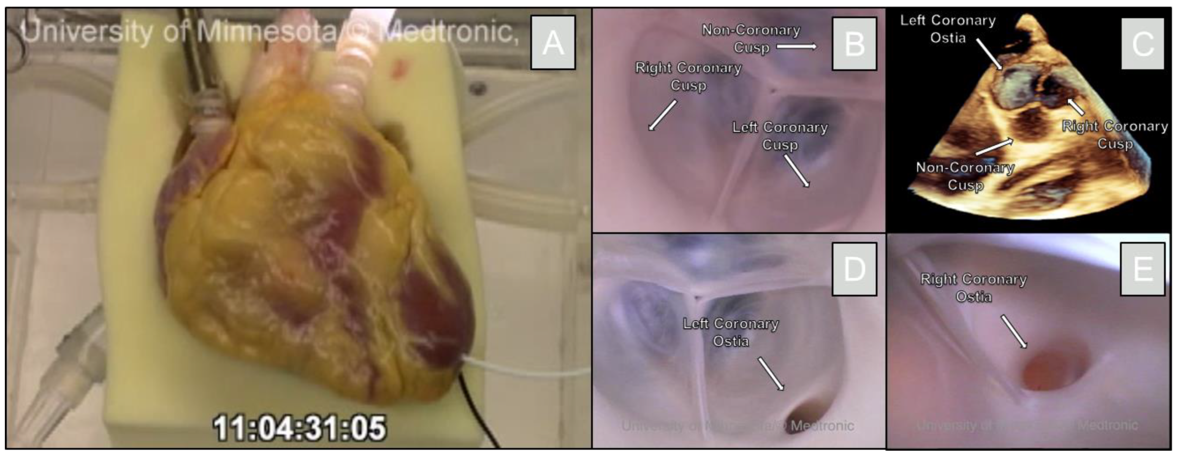 Houston Methodist The Woodlands now offers two Transcatheter Aortic Valve  Replacement Options - Hello Woodlands