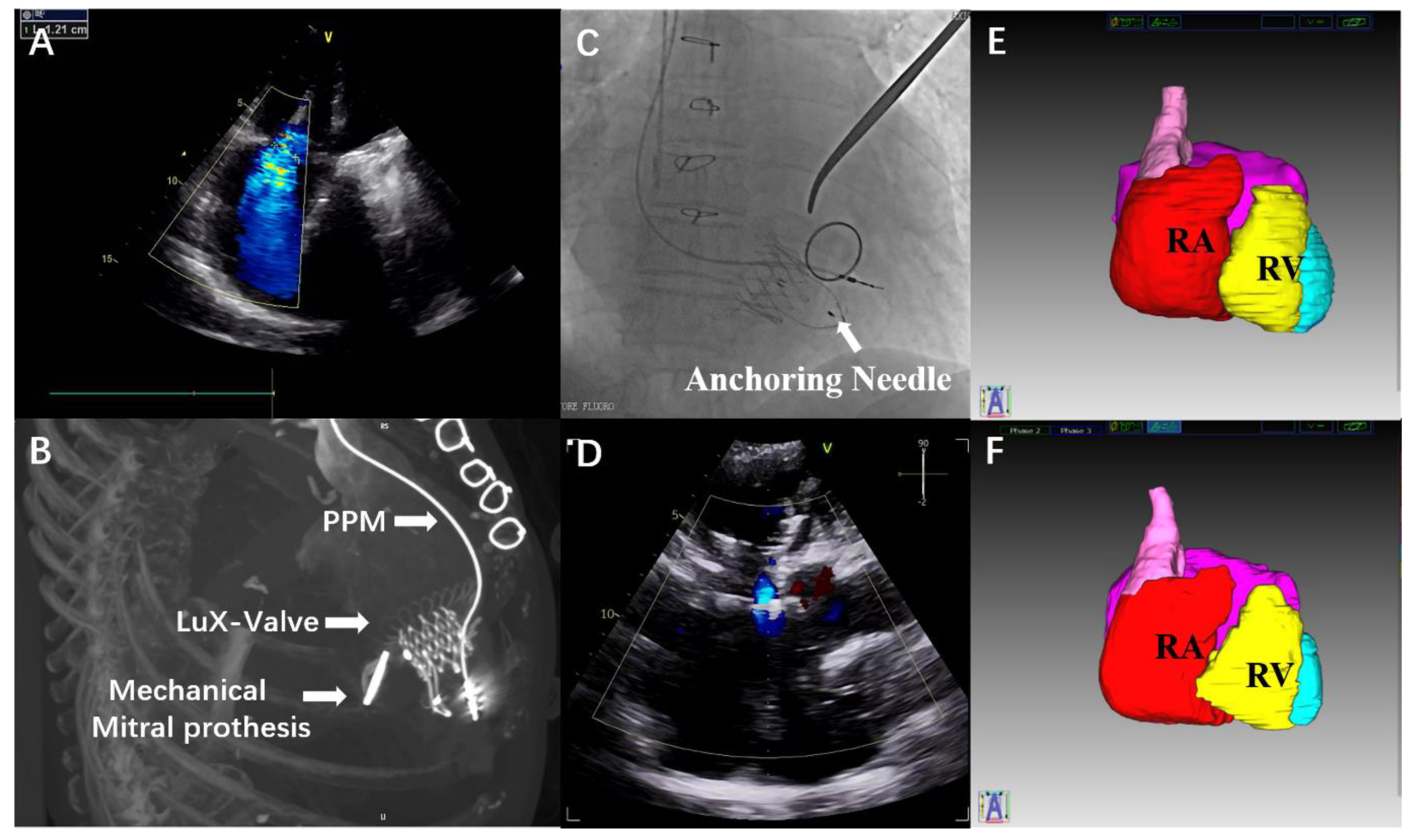 JCDD | Free Full-Text | 4-Year Follow-Up after Transatrial Transcatheter  Tricuspid Valve Replacement with the LuX-Valve