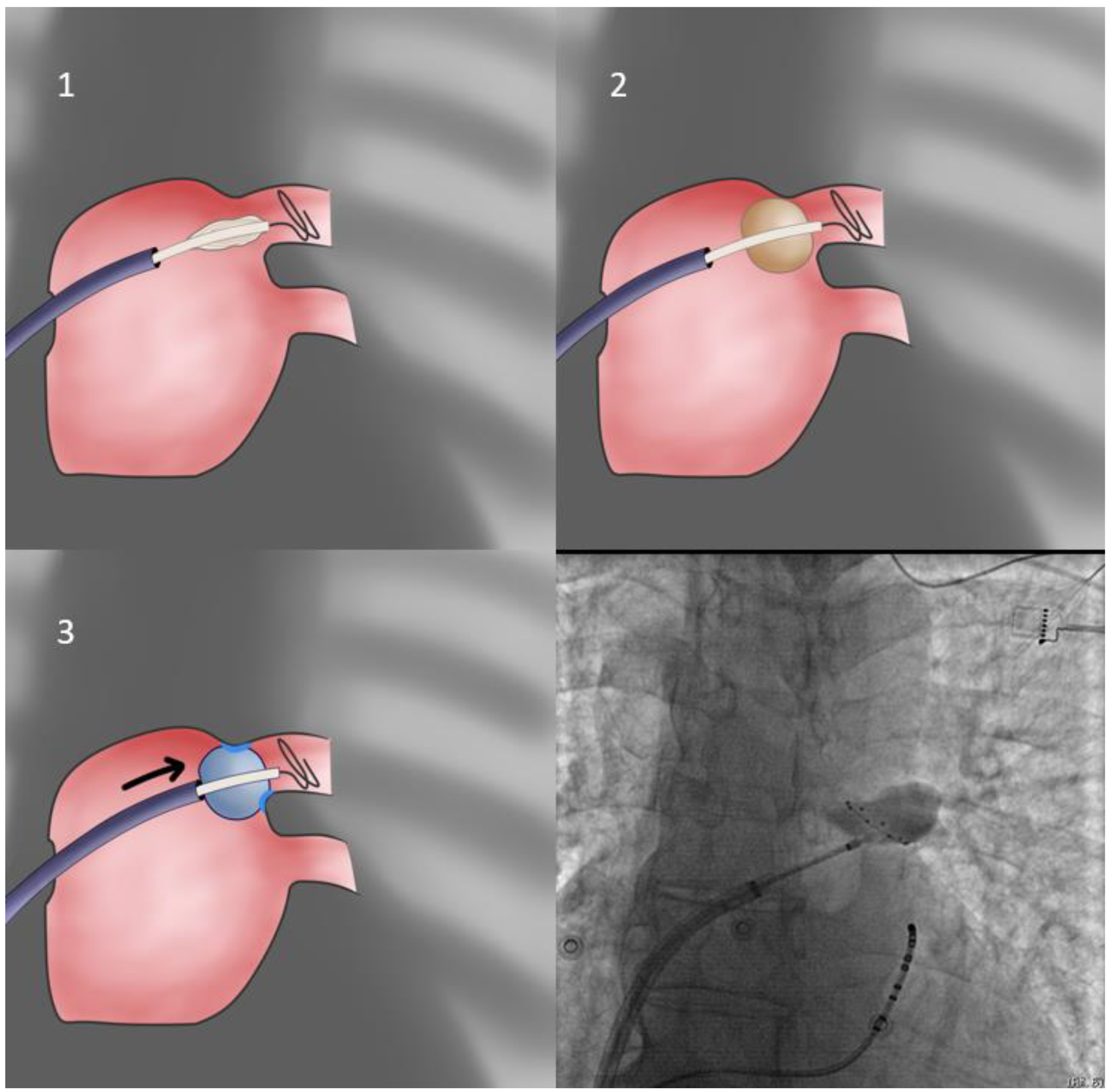 JCDD | Free Full-Text | Best Practice Guide for Cryoballoon Ablation in  Atrial Fibrillation: The Compilation Experience of More than 1000 Procedures