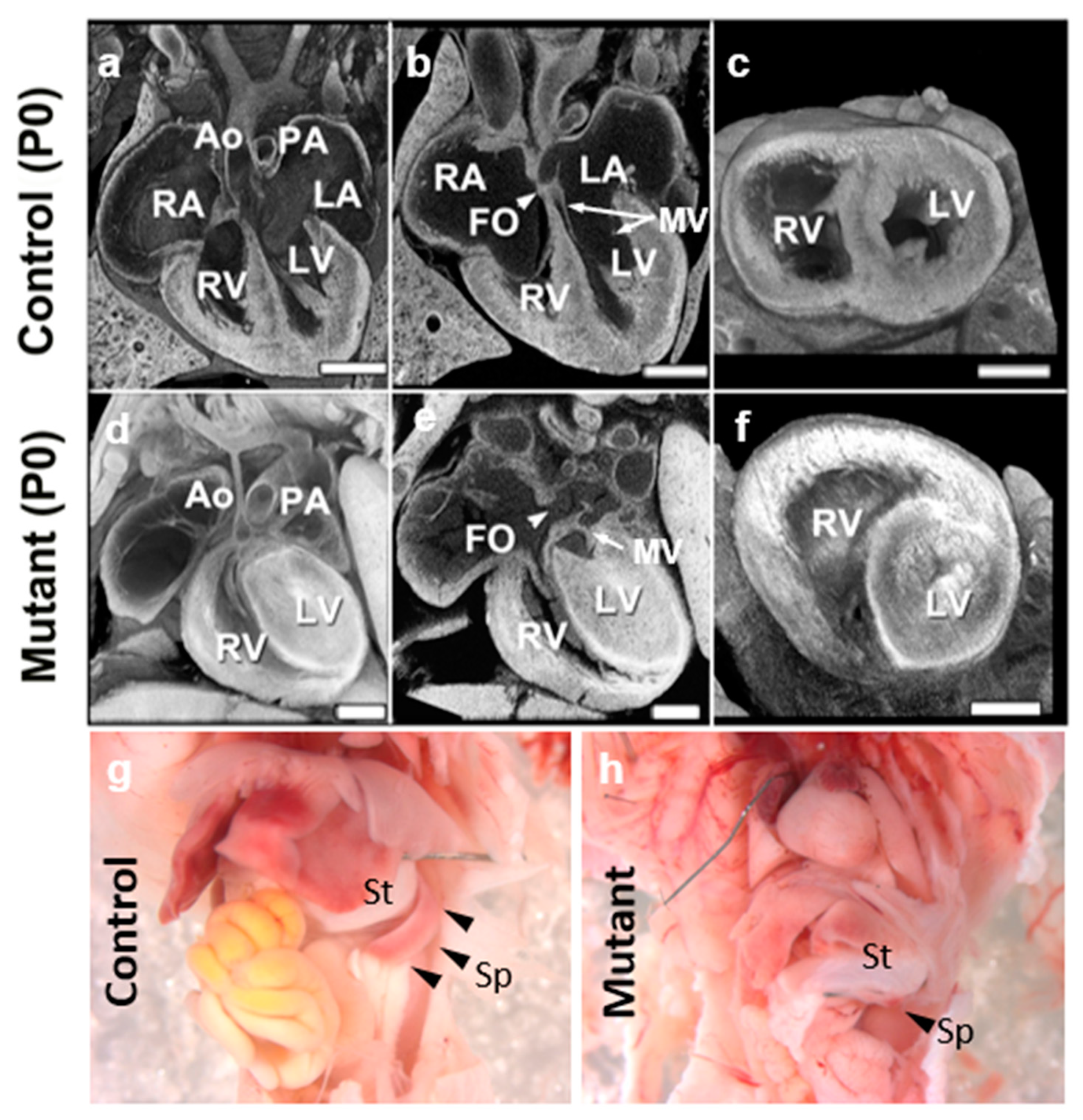 Isolated Left Ventricular Apical Hypoplasia